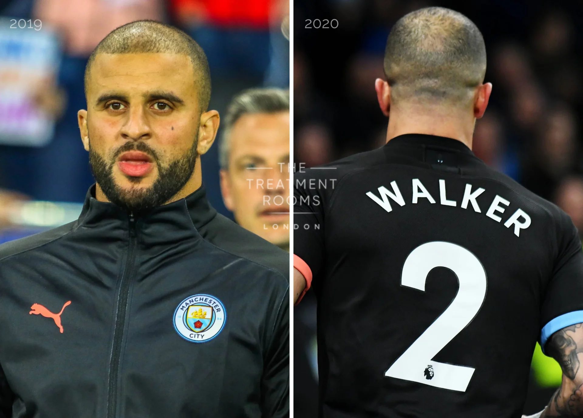 Kyle Walker in 2019 (hairline) and 2020 (crown)