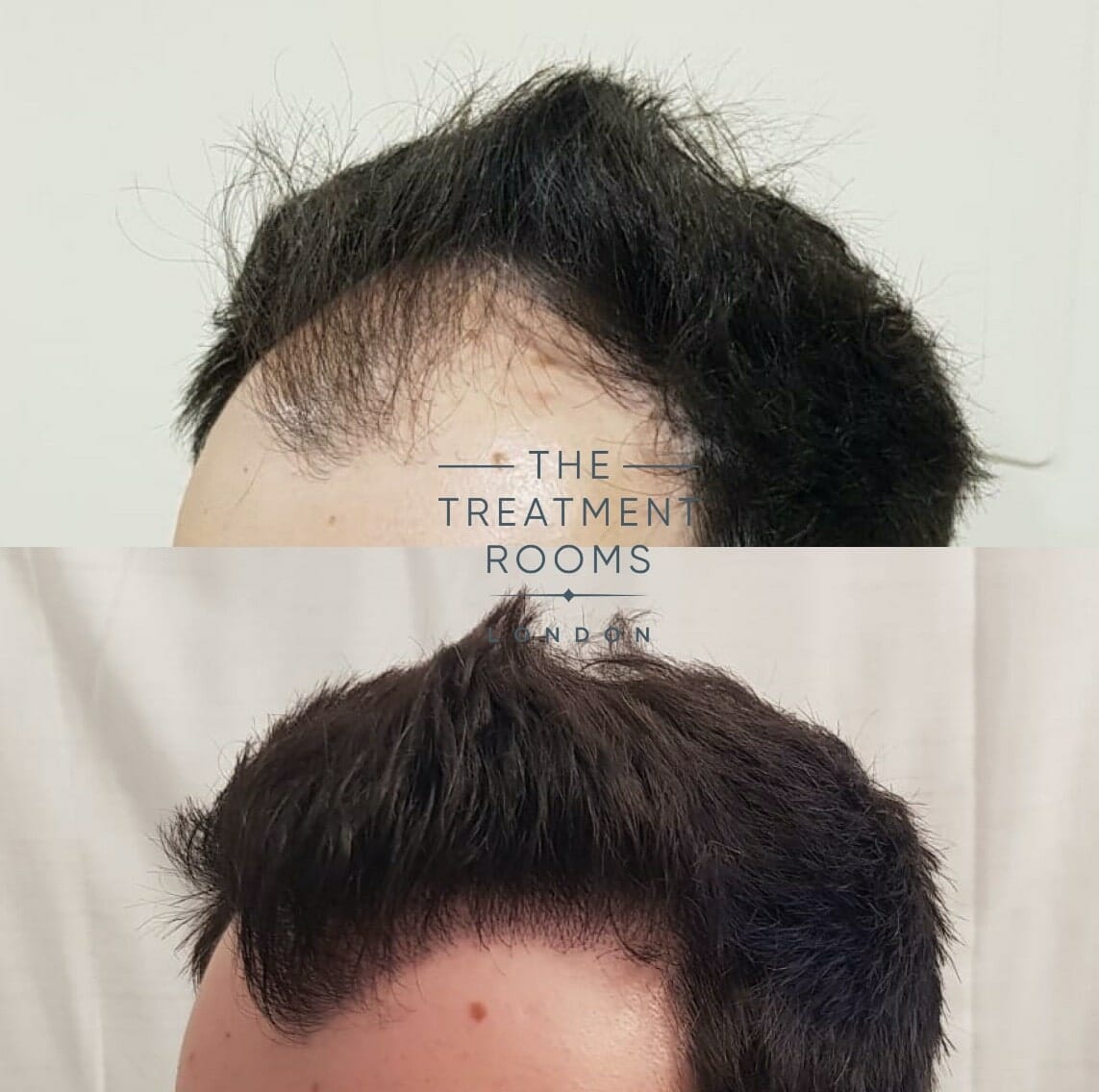 Left Hairline FUE Hair Transplant Left Hairline FUE Hair Transplant