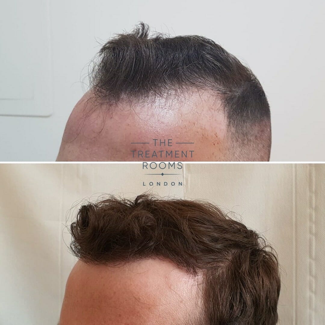 Left Temporal Hairline Hair Transplant London Before and After
