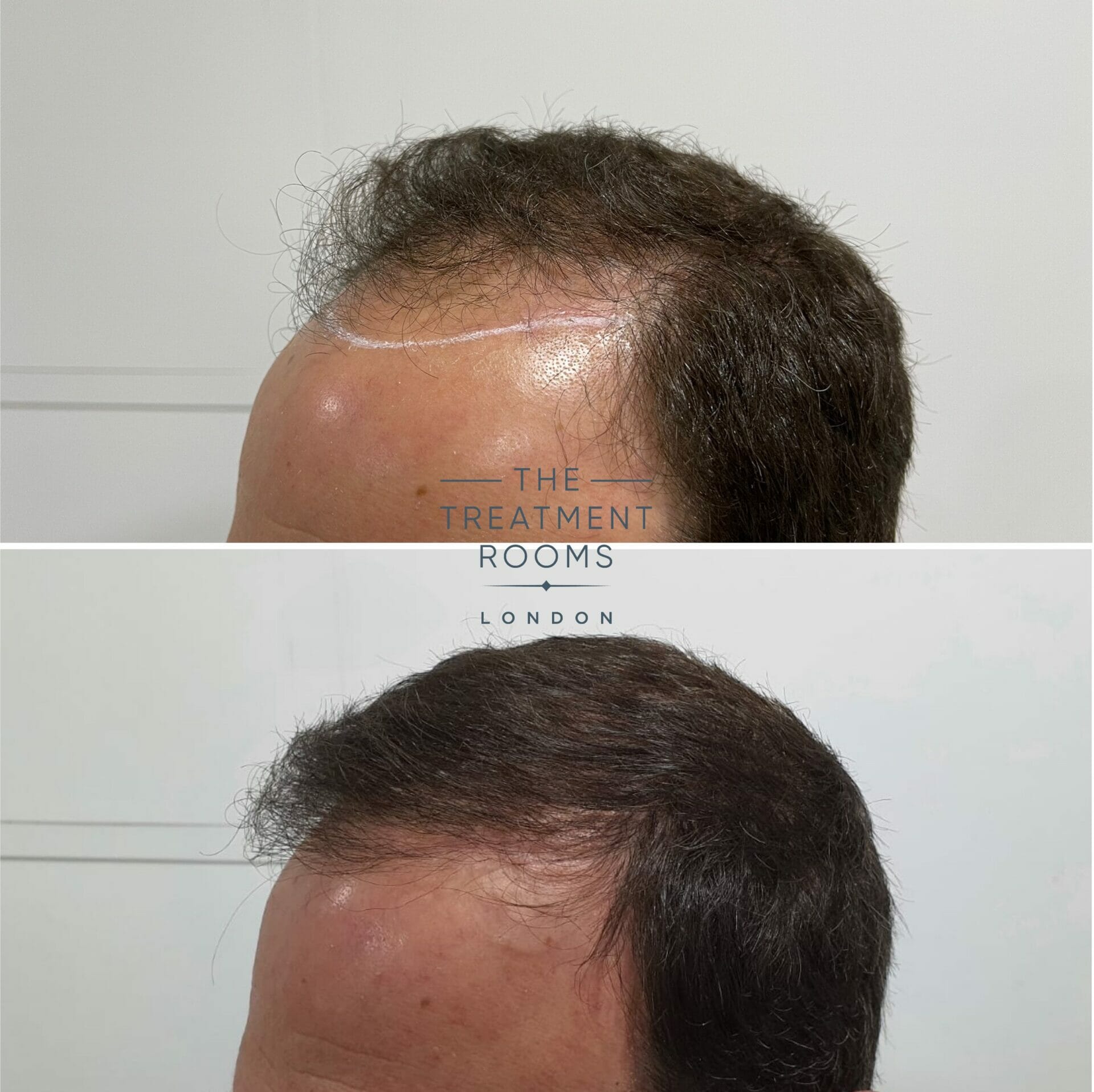 Norwood 4 FUE hair transplant result 1930 grafts Norwood 4 FUE hair transplant result 1930 grafts