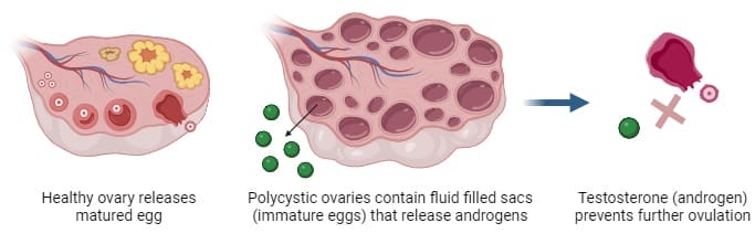 PCOS explanation diagram