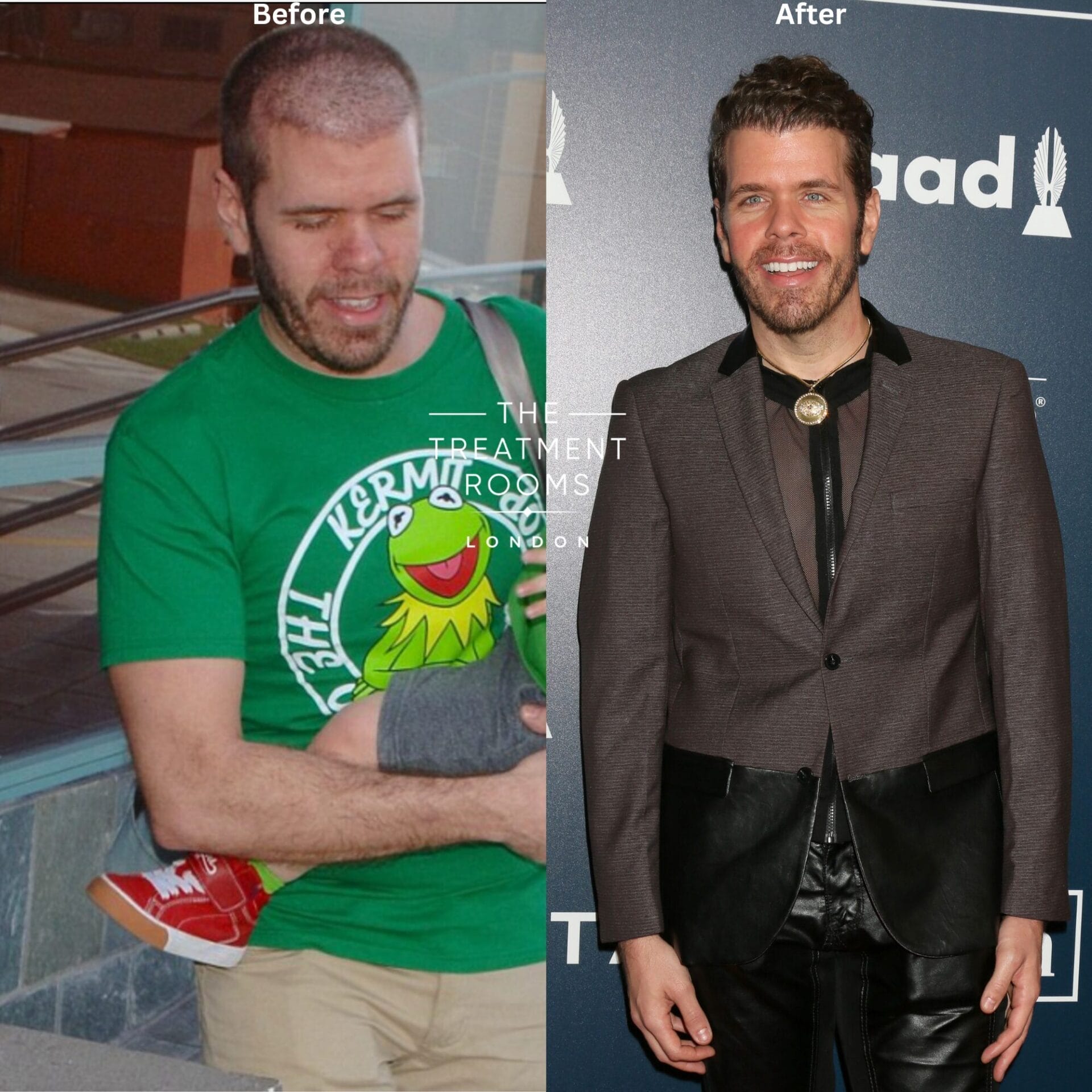 Perez Hilton Before-and-After Hair Transplant