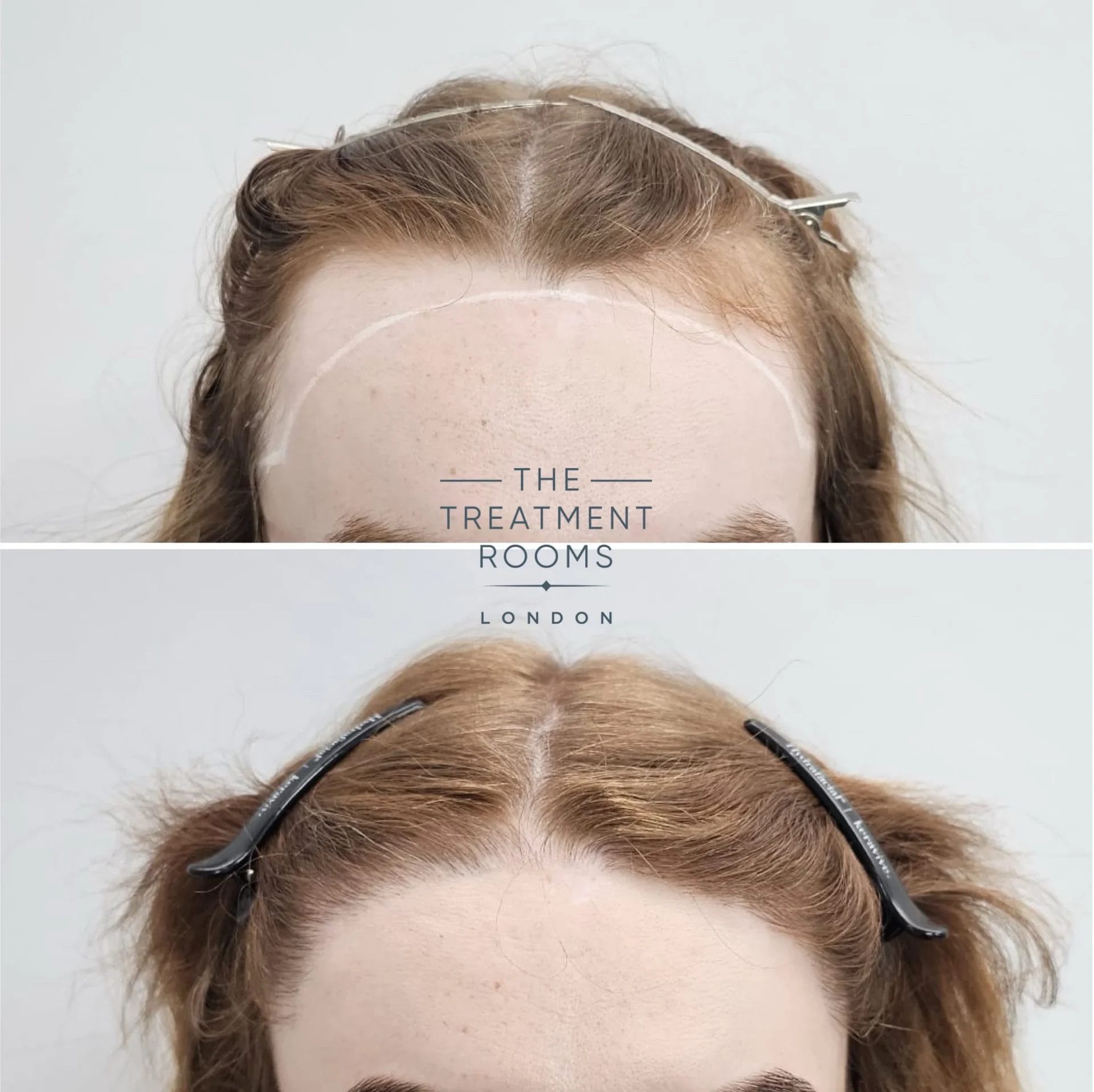 transgender fut hair transplant london before and after 1868 grafts