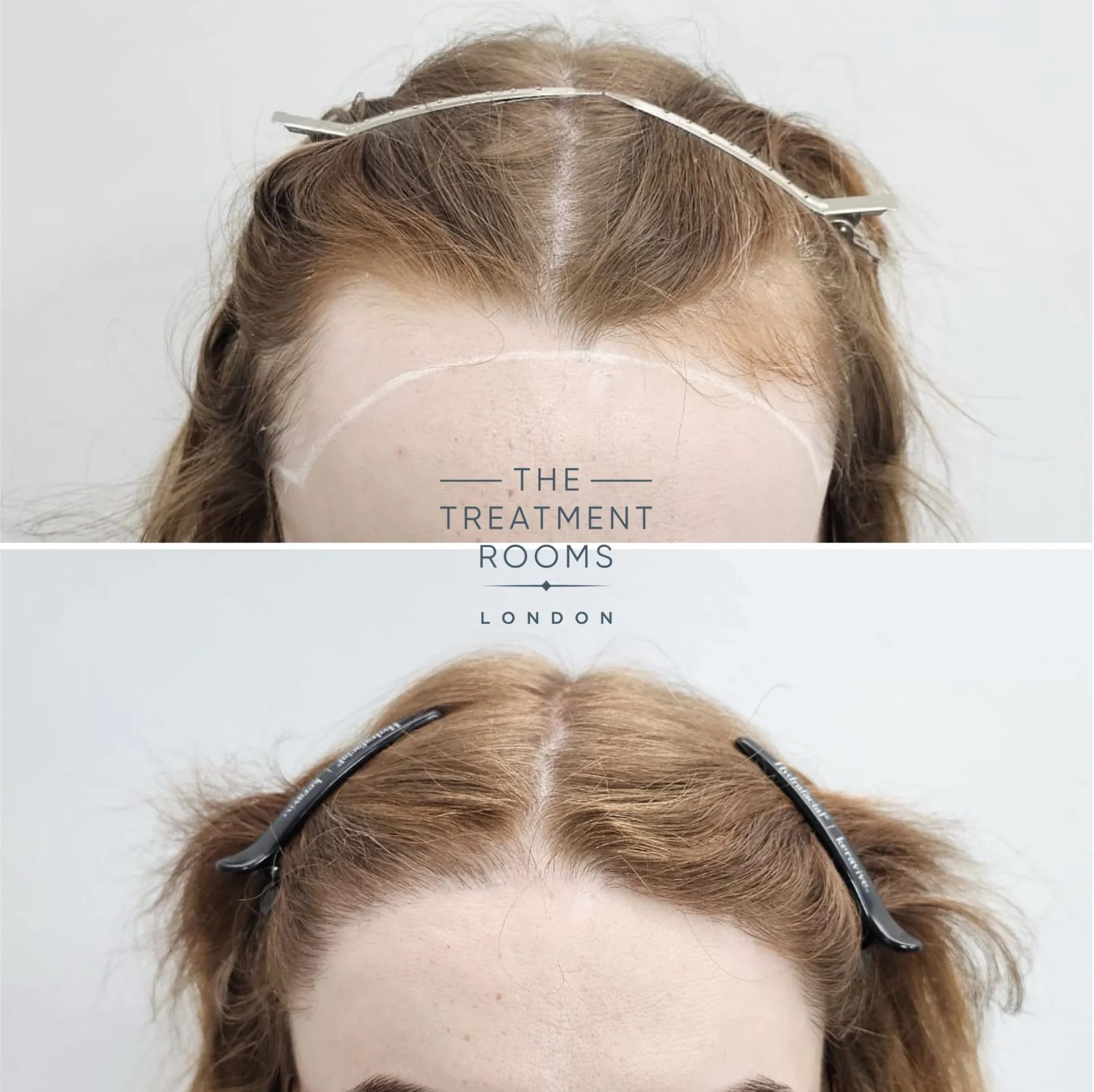 transgender fut hair transplant before and after 1868 grafts