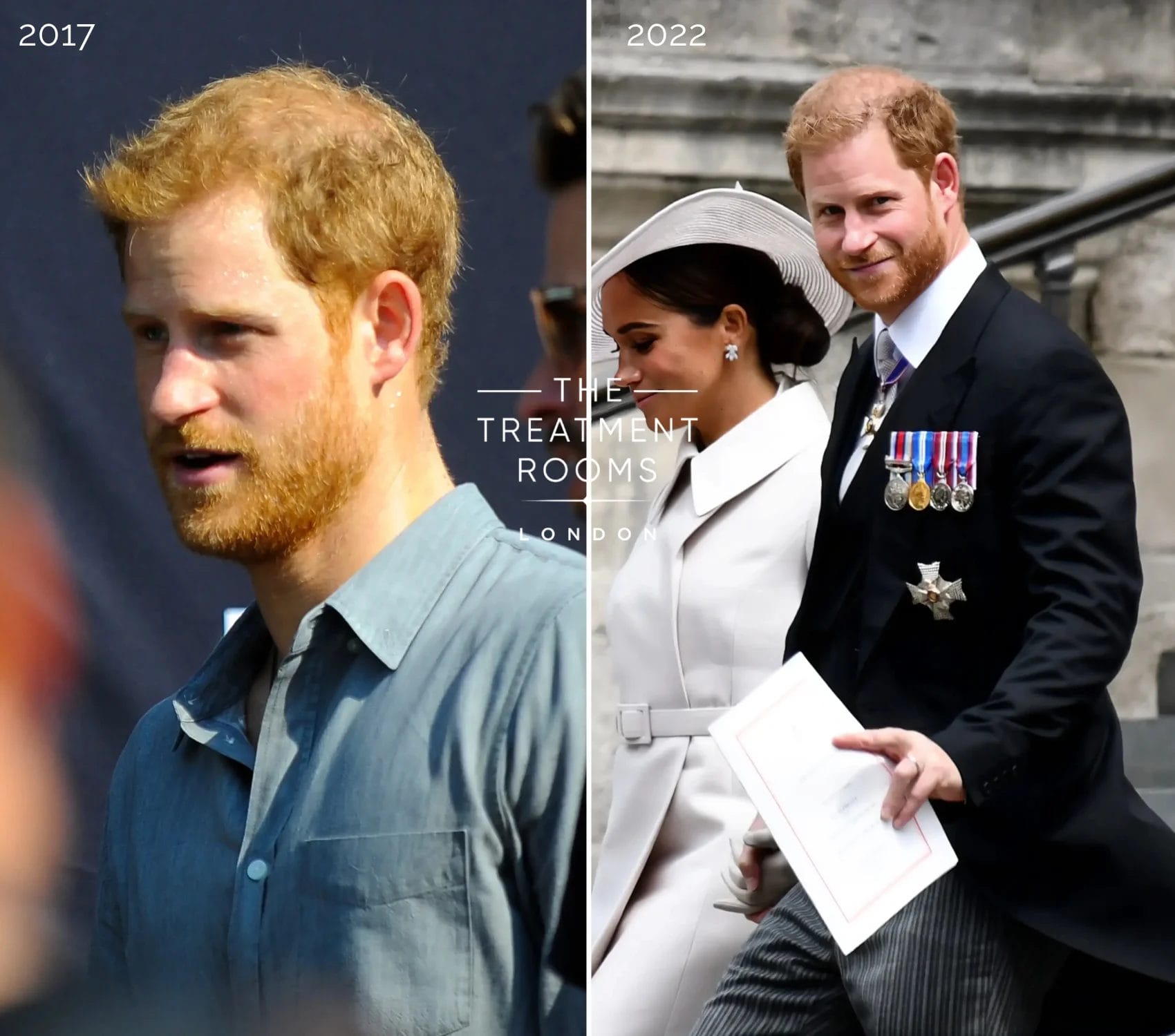 Prince Harry in 2017, showing early thinning at the crown, with noticeable progression by 2022
