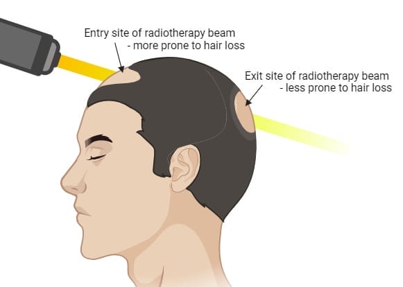 Radiotherapy induced hair loss