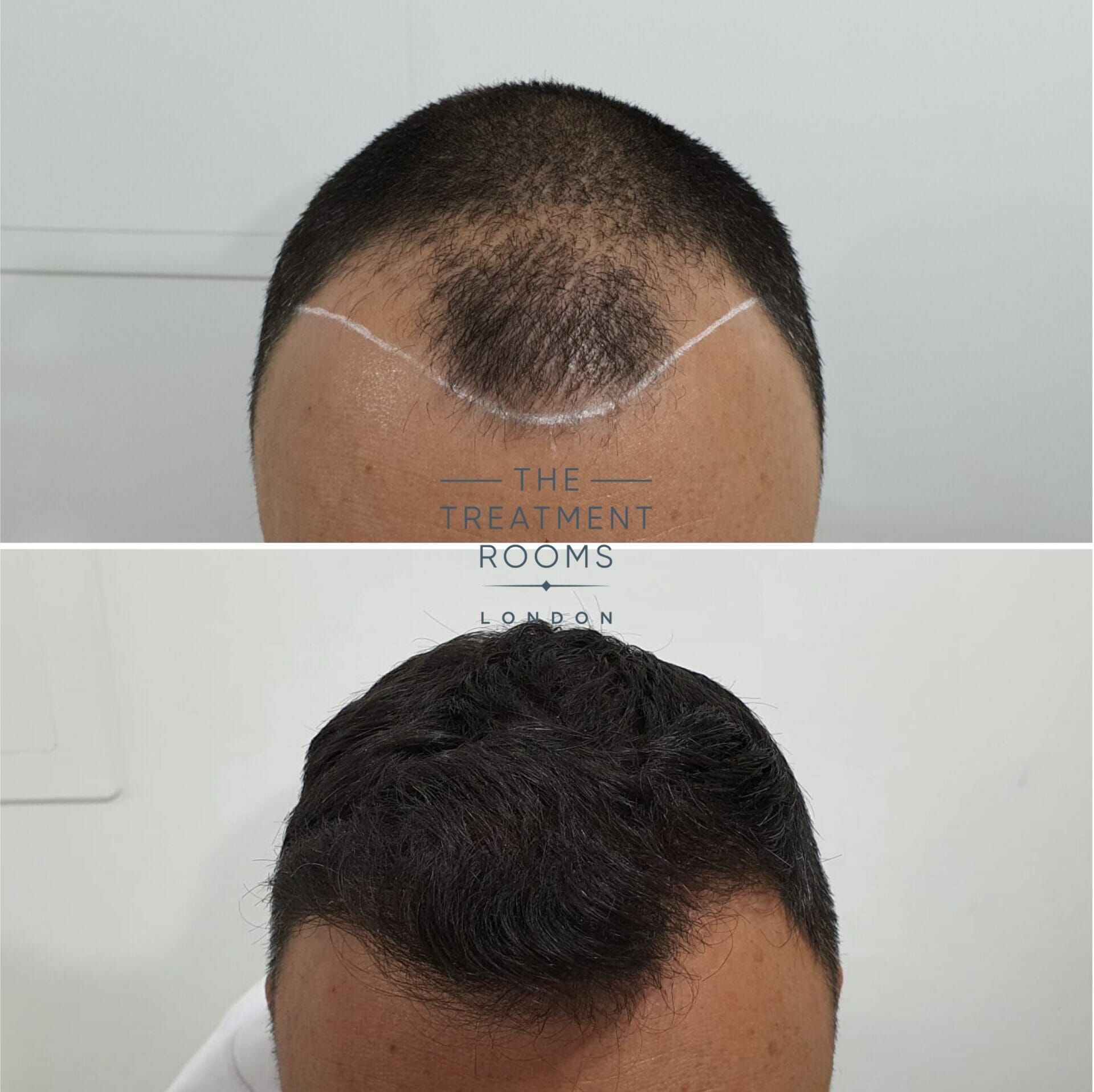 Receding hairline FUE hair transplant before and after 1498 grafts Receding hairline FUE hair transplant before and after 1498 grafts