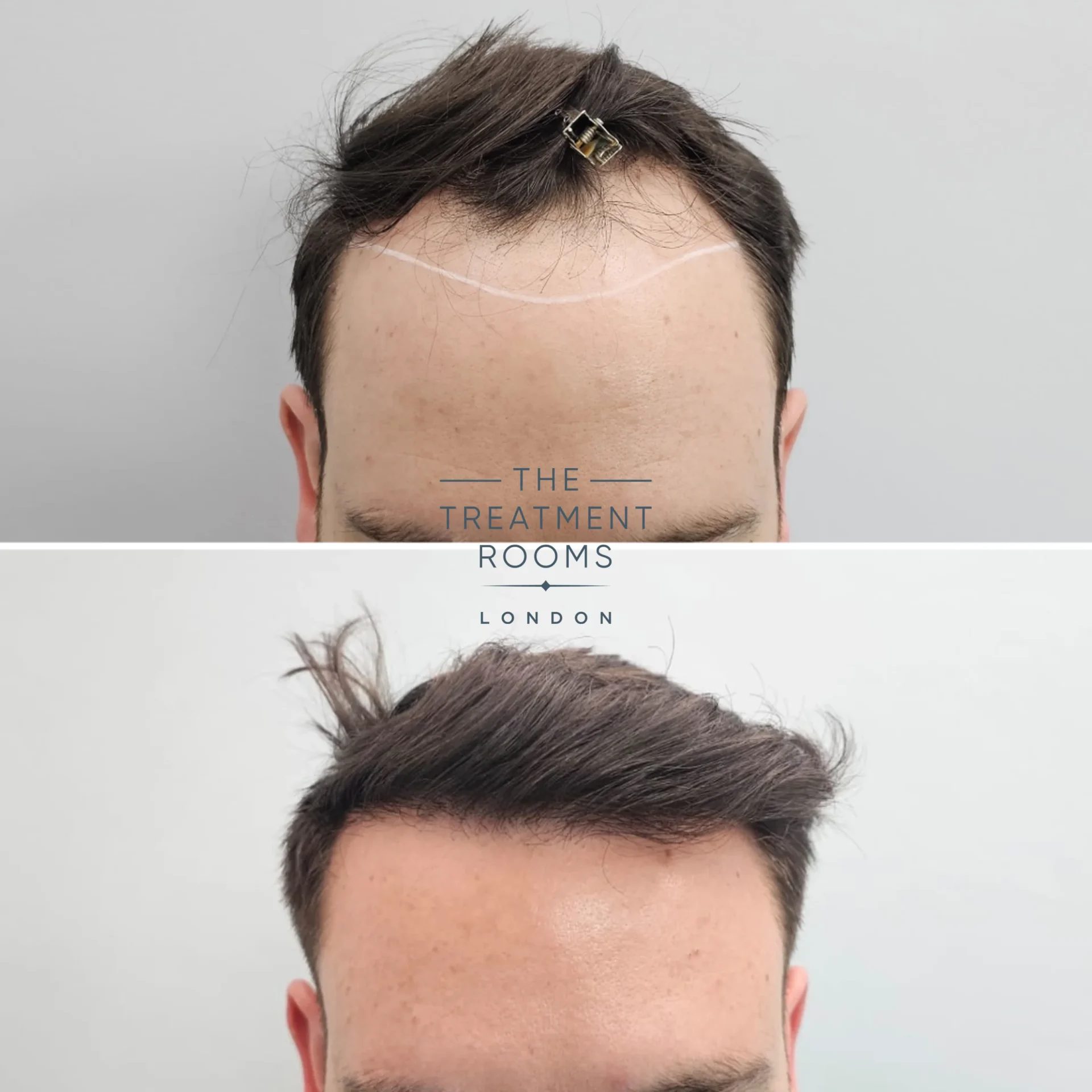 Receding hairline before and after 2247 grafts