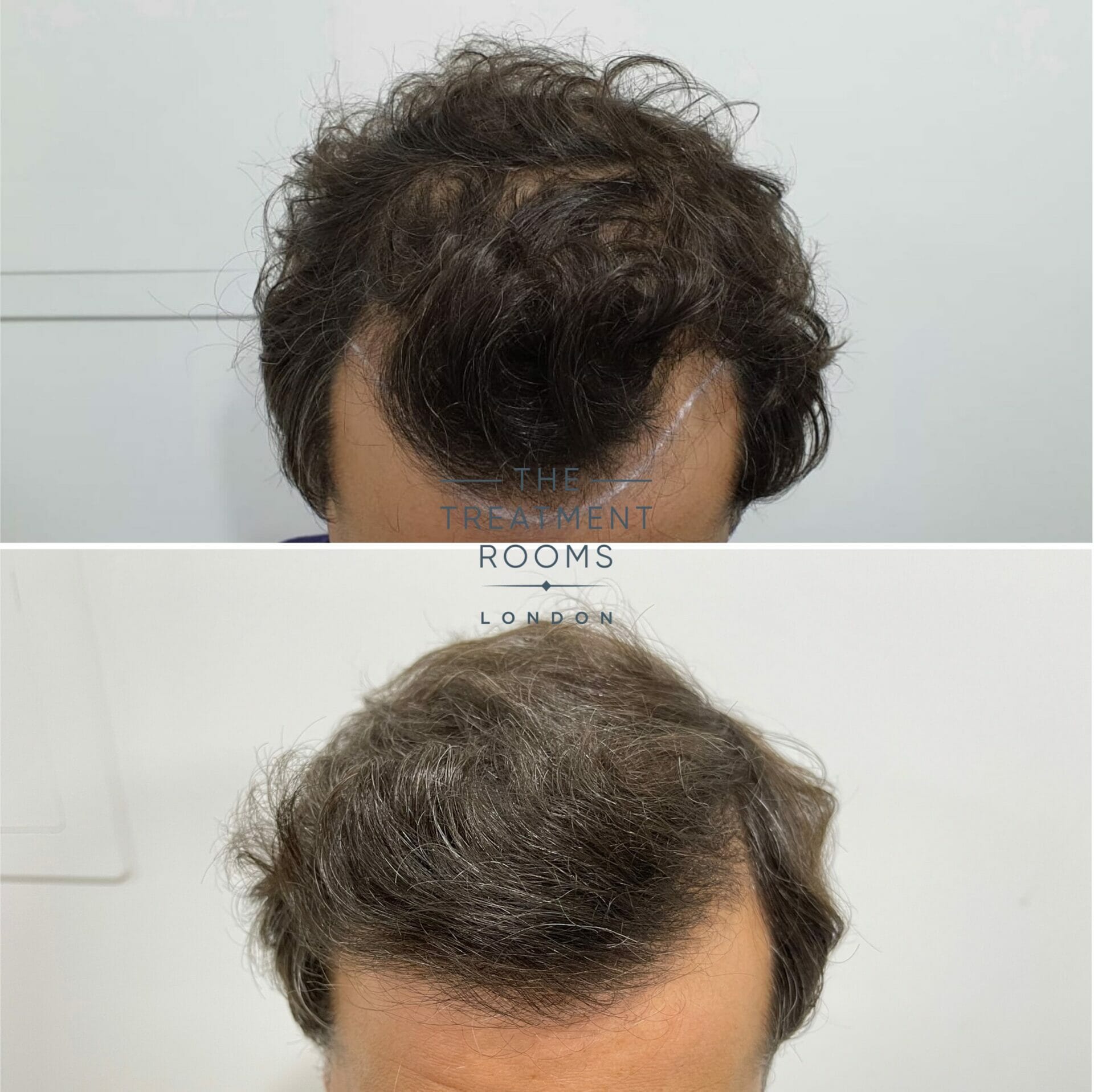 Receding hairline hair transplant result Receding hairline hair transplant result