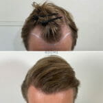 Receding hairline hair transplant result