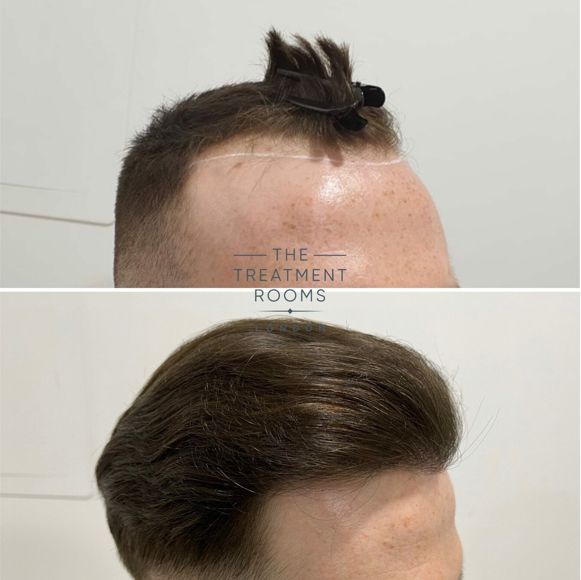 Receding hairline result