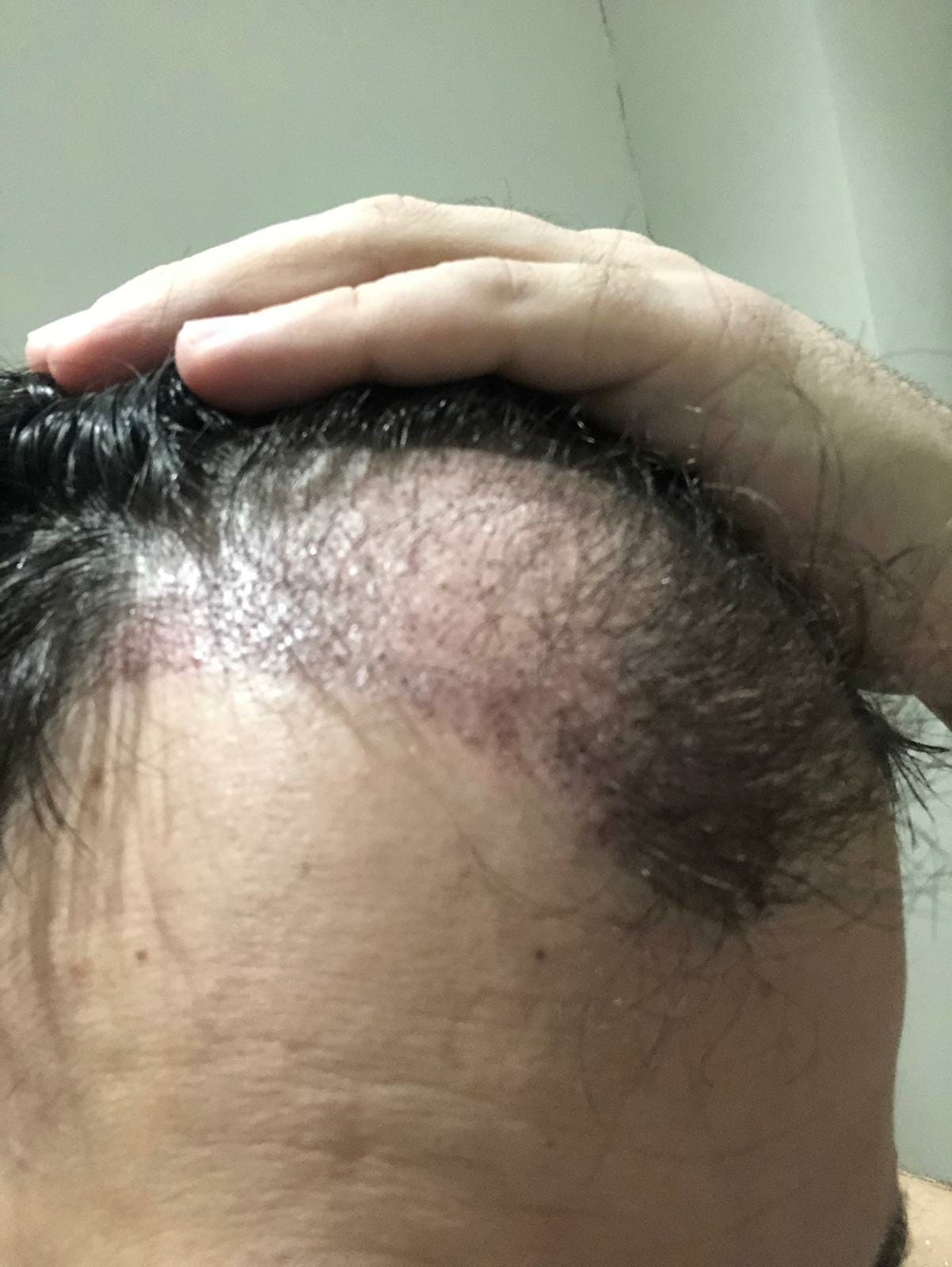 Redness after hair transplant