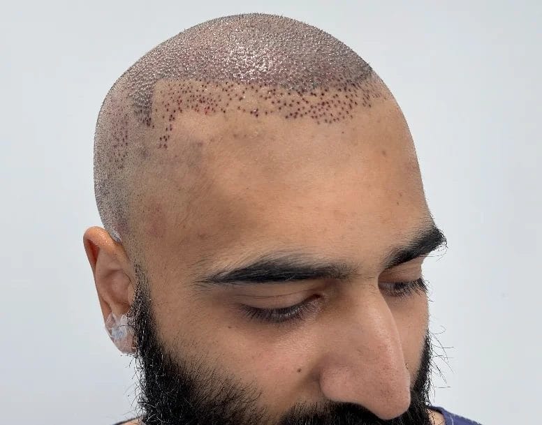 Repair of failed hair transplant