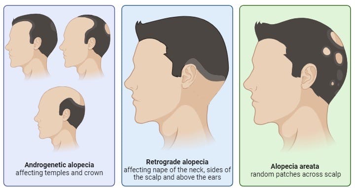 Retrograde alopecia diagram