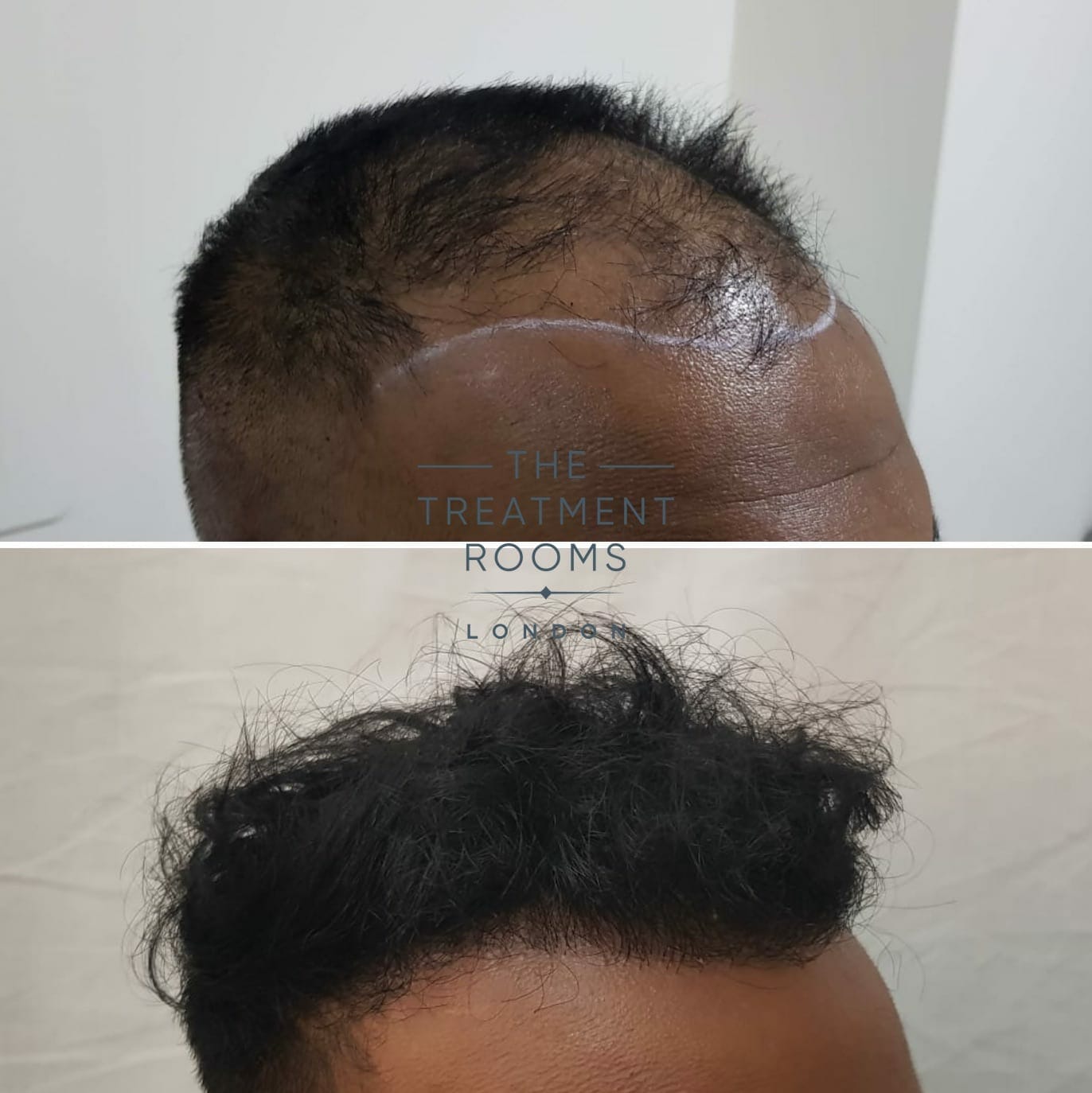 Right FUE hair transplant london FUE hair transplant before and after 1800 grafts