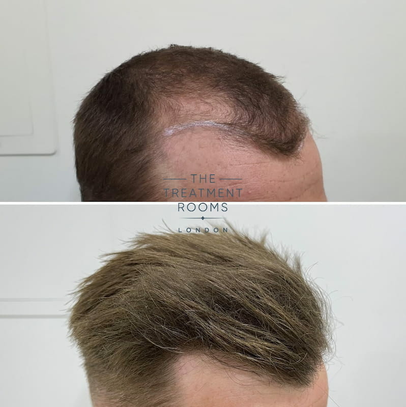 Right hairline FUE hair transplant result temple FUE hair transplant before and after