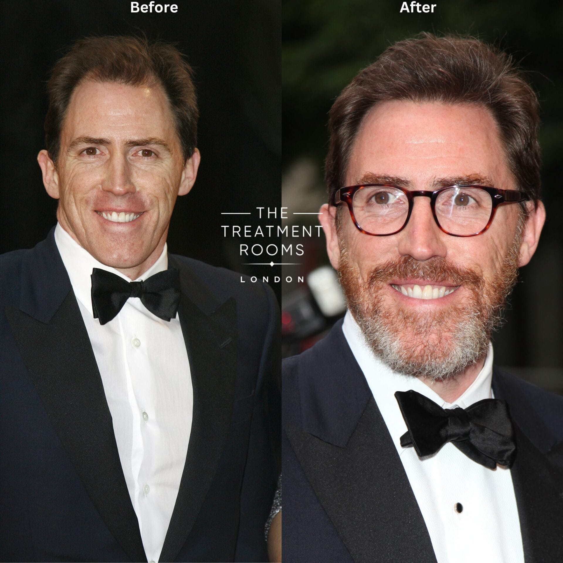 image of showing Rob Brydon before  having hair transplant and after his hair transplant