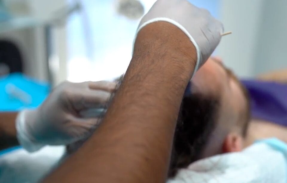 hair transplant surgery