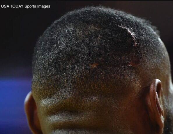 image showing injury on lebron james head after an accident with a camera during a game