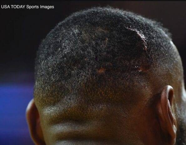 Image Courtesy Usa Today Sports Image image showing injury on lebron james head after an accident with a camera during a game