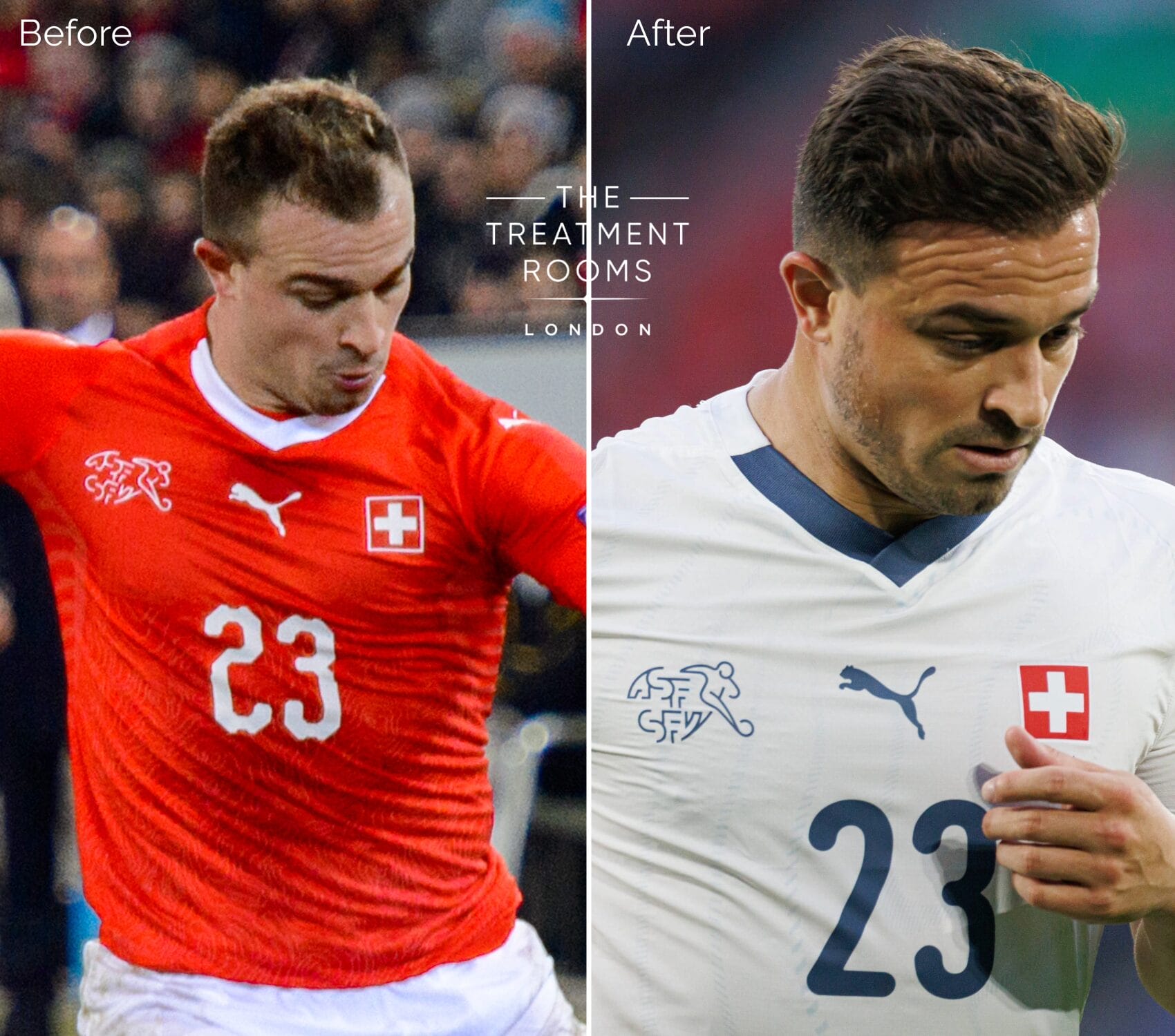 Before and after images of Xherdan Shaqiri from 2018 and 2024, showing visible improvement in hair density and a restored hairline, suggesting a possible hair transplant