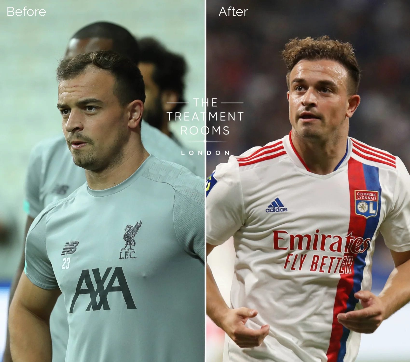 Before and after images of Xherdan Shaqiri from 2019 and 2024, showing a visibly fuller and more defined hairline