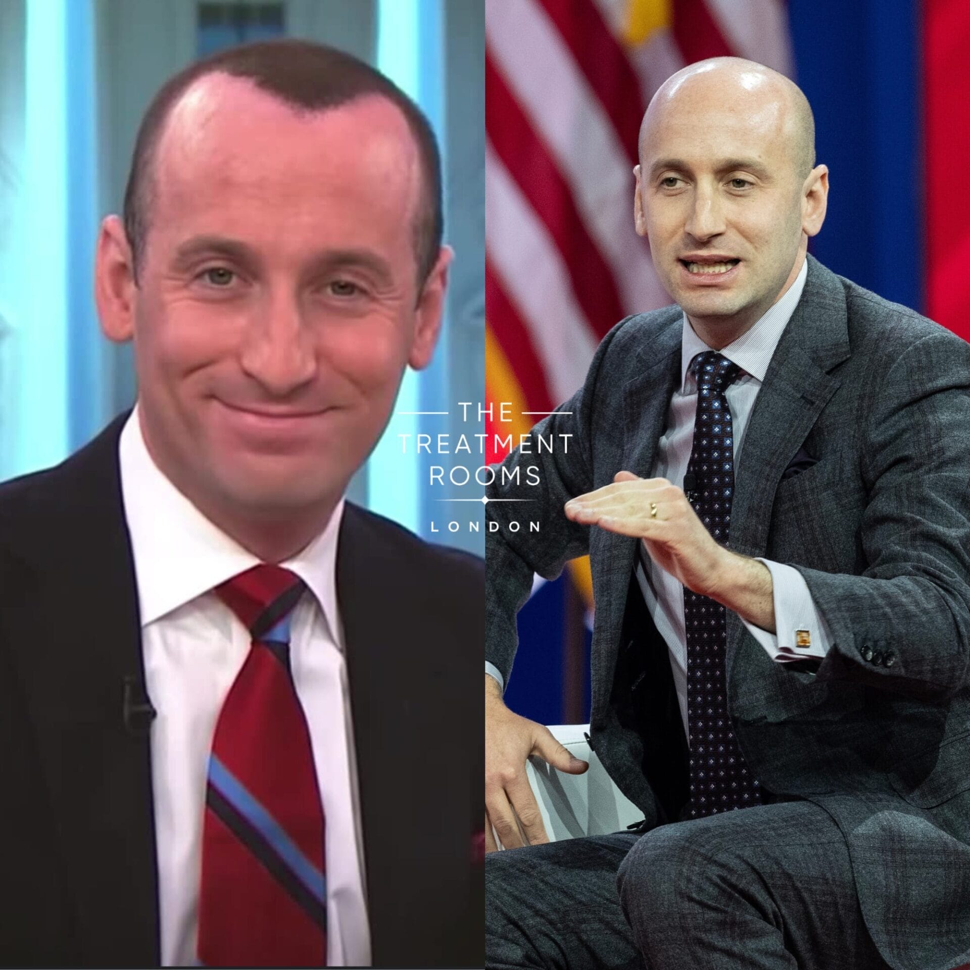 image showing Stephen Miller with a hair spray another with his baldness fully showing
