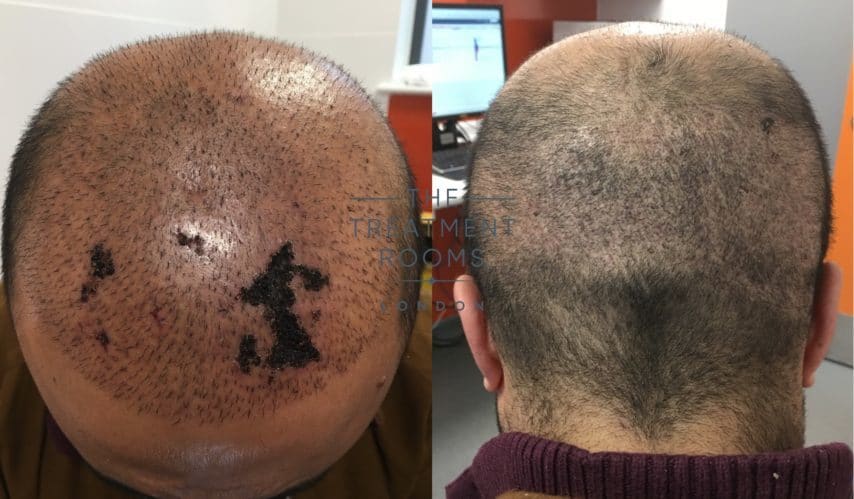 skin necrosis after hair transplant