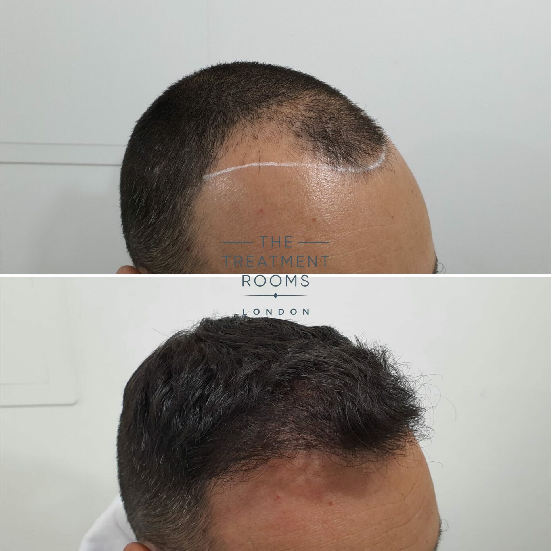 Temple FUE hair transplant result 1498 grafts