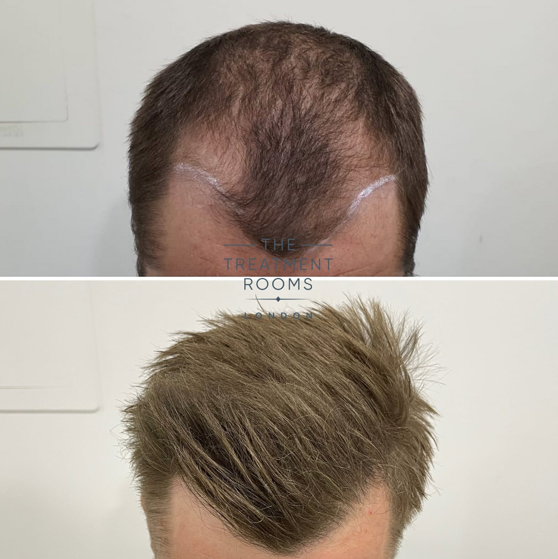Temple hair loss treatment
