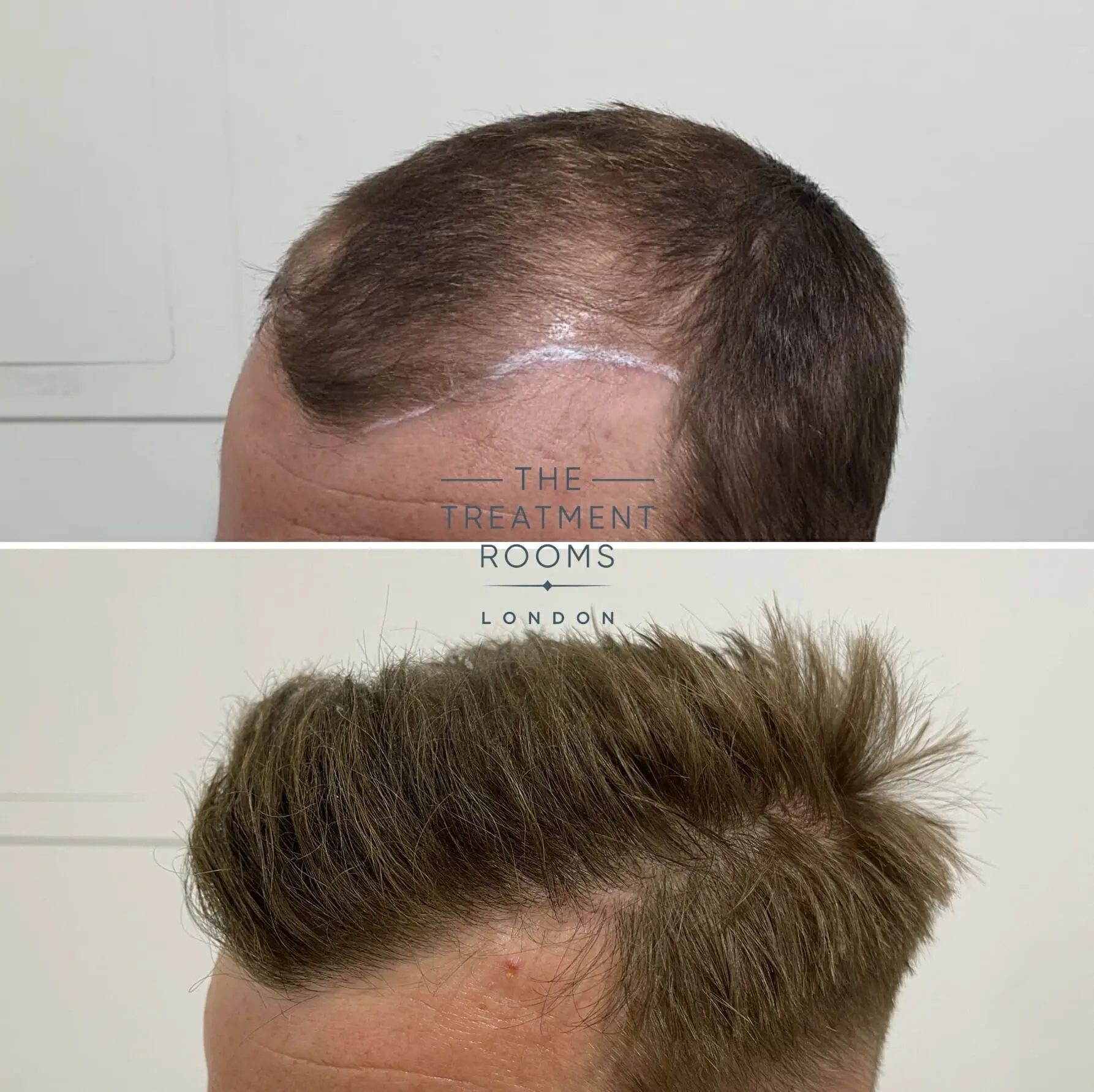 Temple Hair Loss & Temple Hair Transplant | Treatment Rooms London