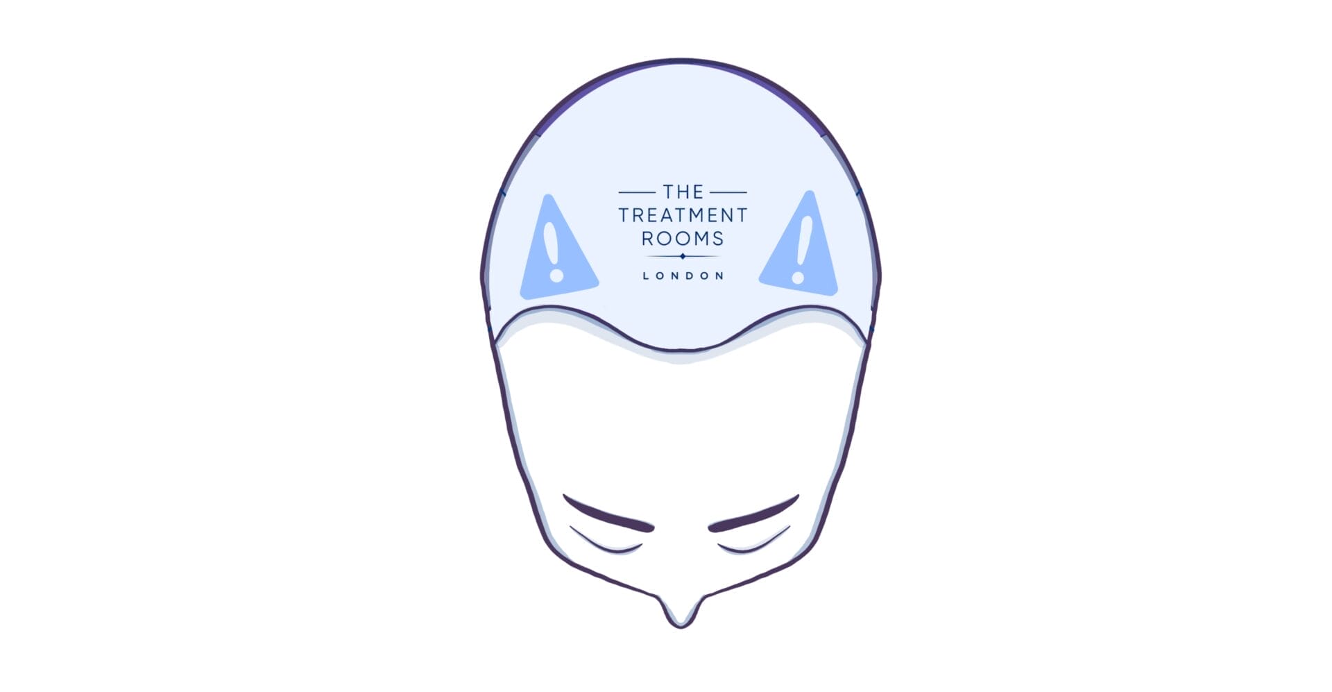 Temporal Triangular Alopecia