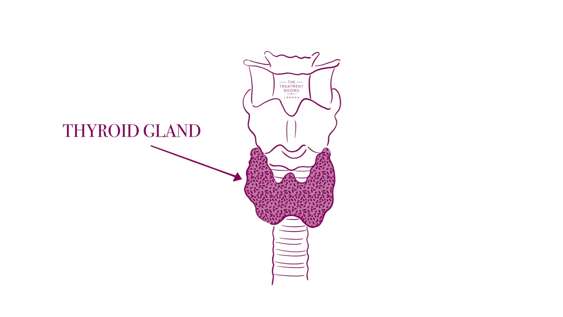 Thyroid hormones and female hair loss