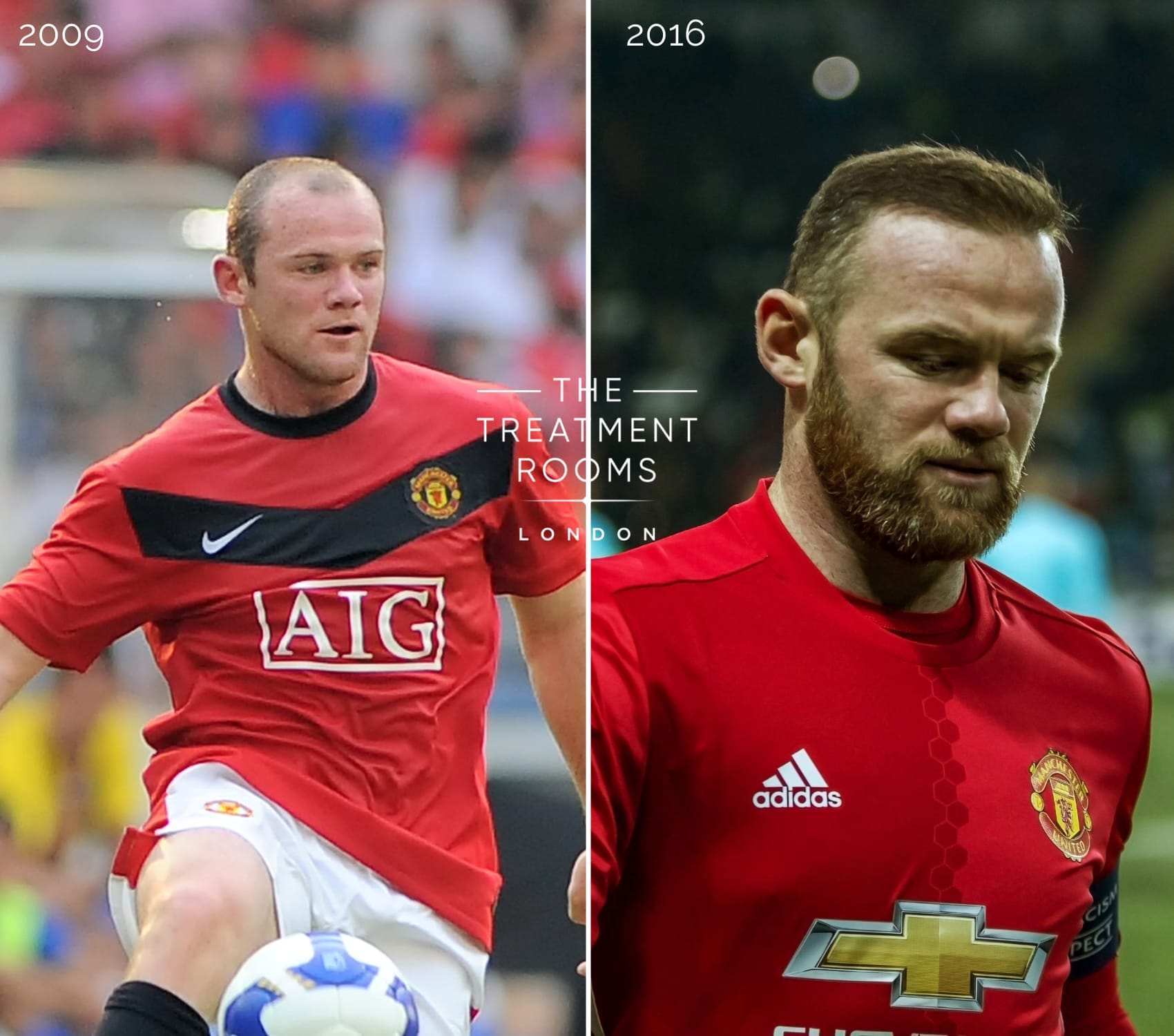 Wayne Rooney showing temple recession in 2009 compared to a fully restored hairline in 2016