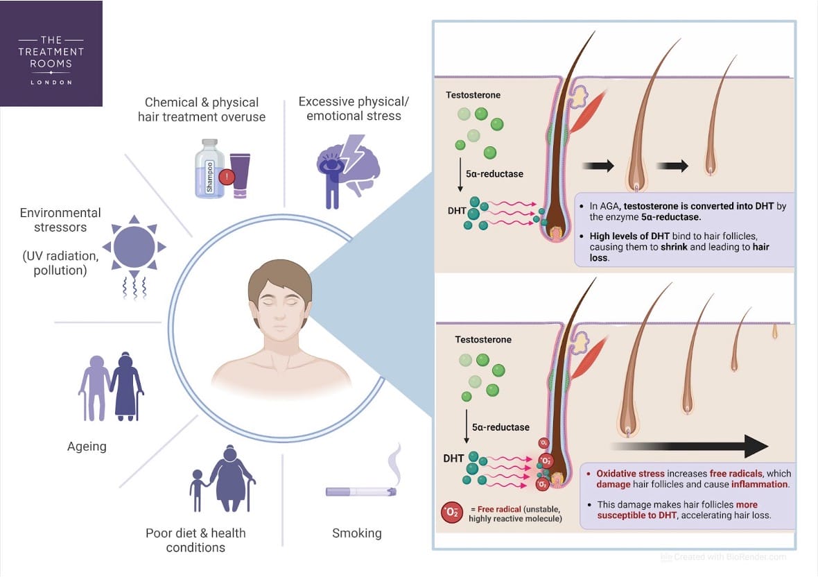 androgen hormones and hairline recession in women