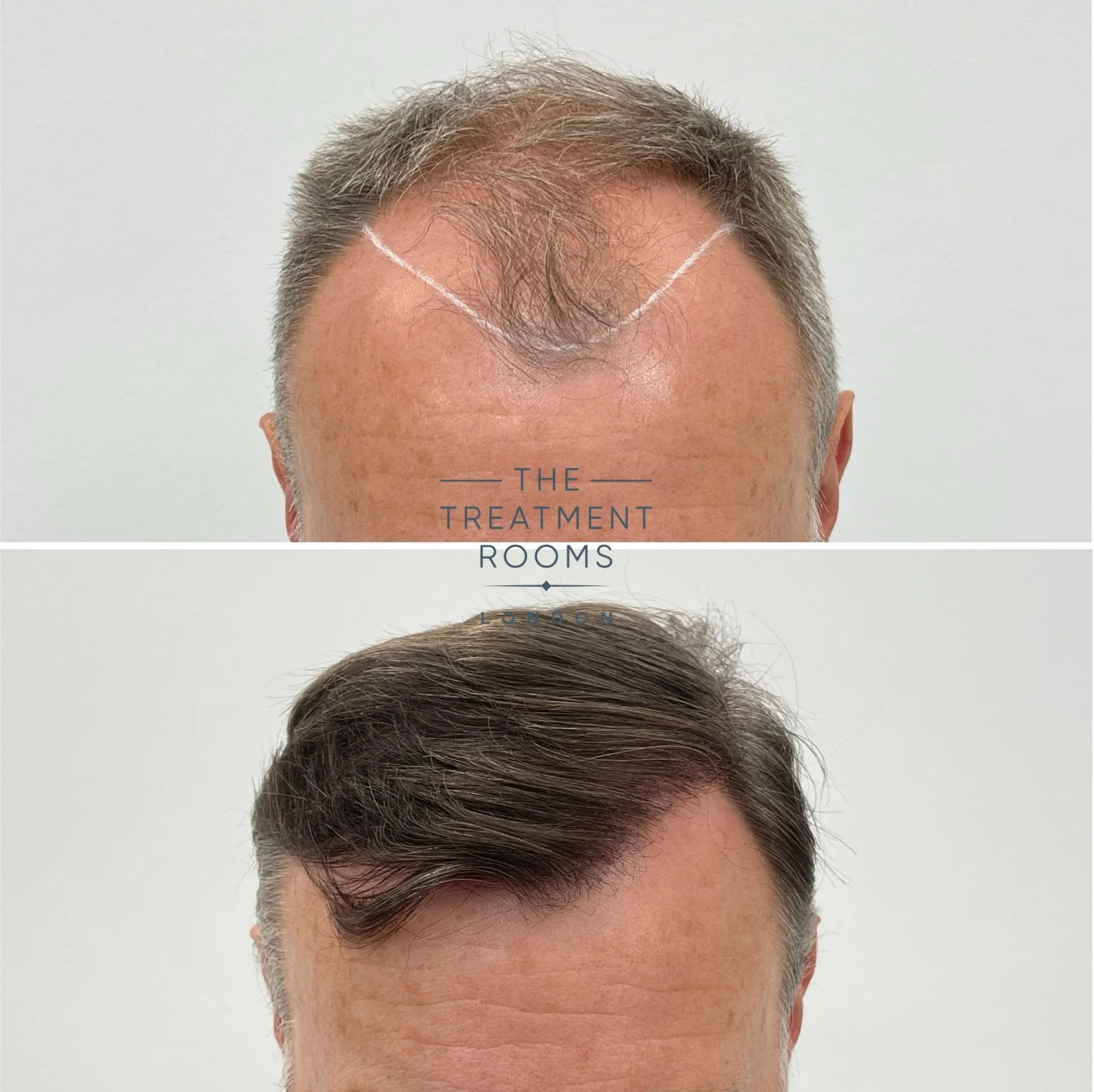 award winning hair transplant 2078 grafts before and after