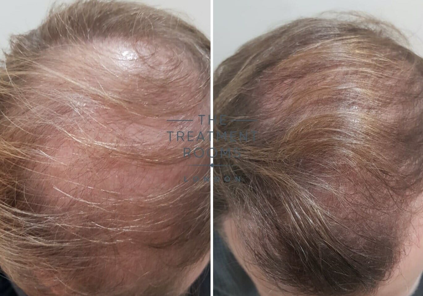 Crown hair transplant result london Crown hair transplant result london