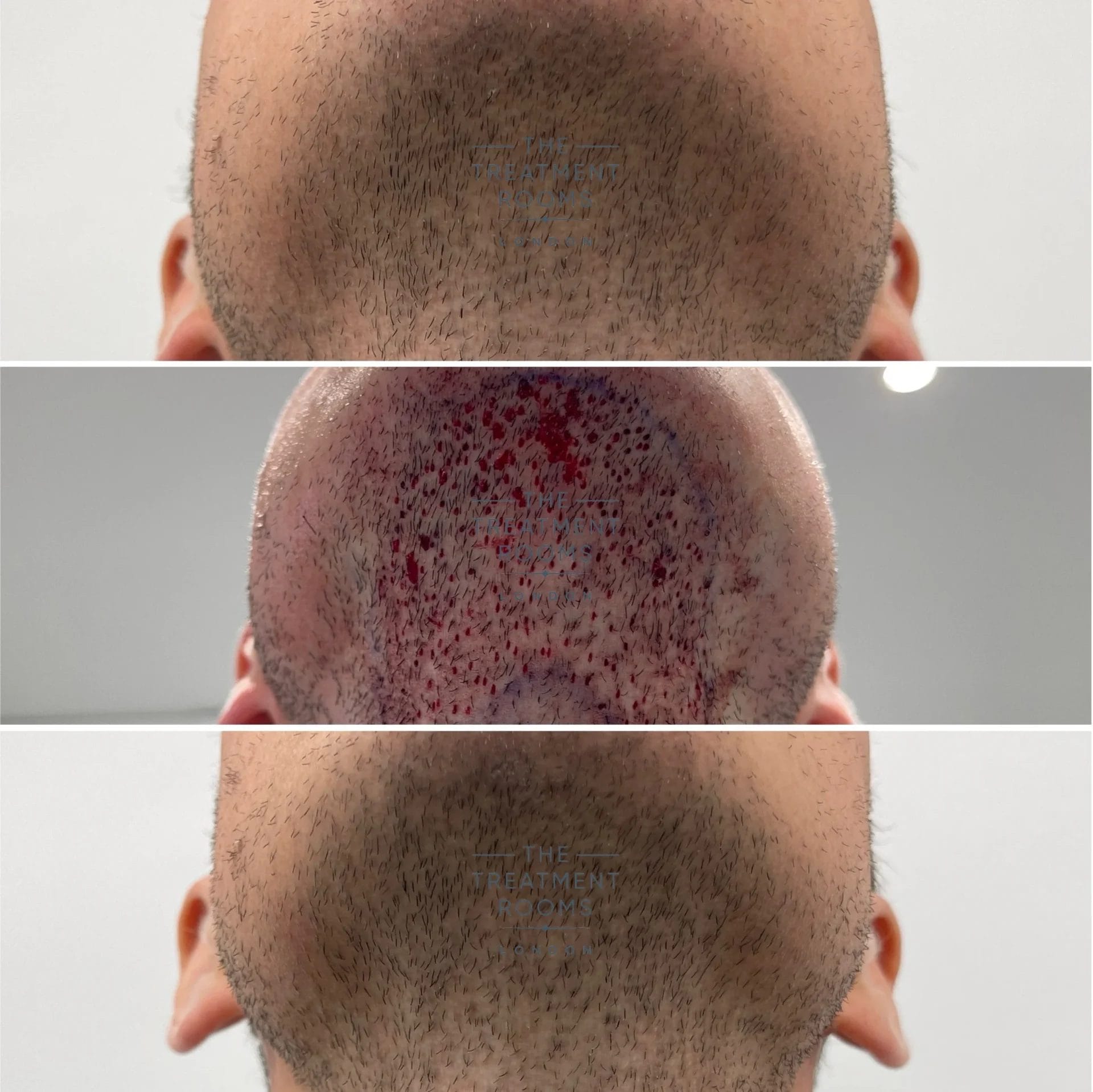 beard donor area recovery