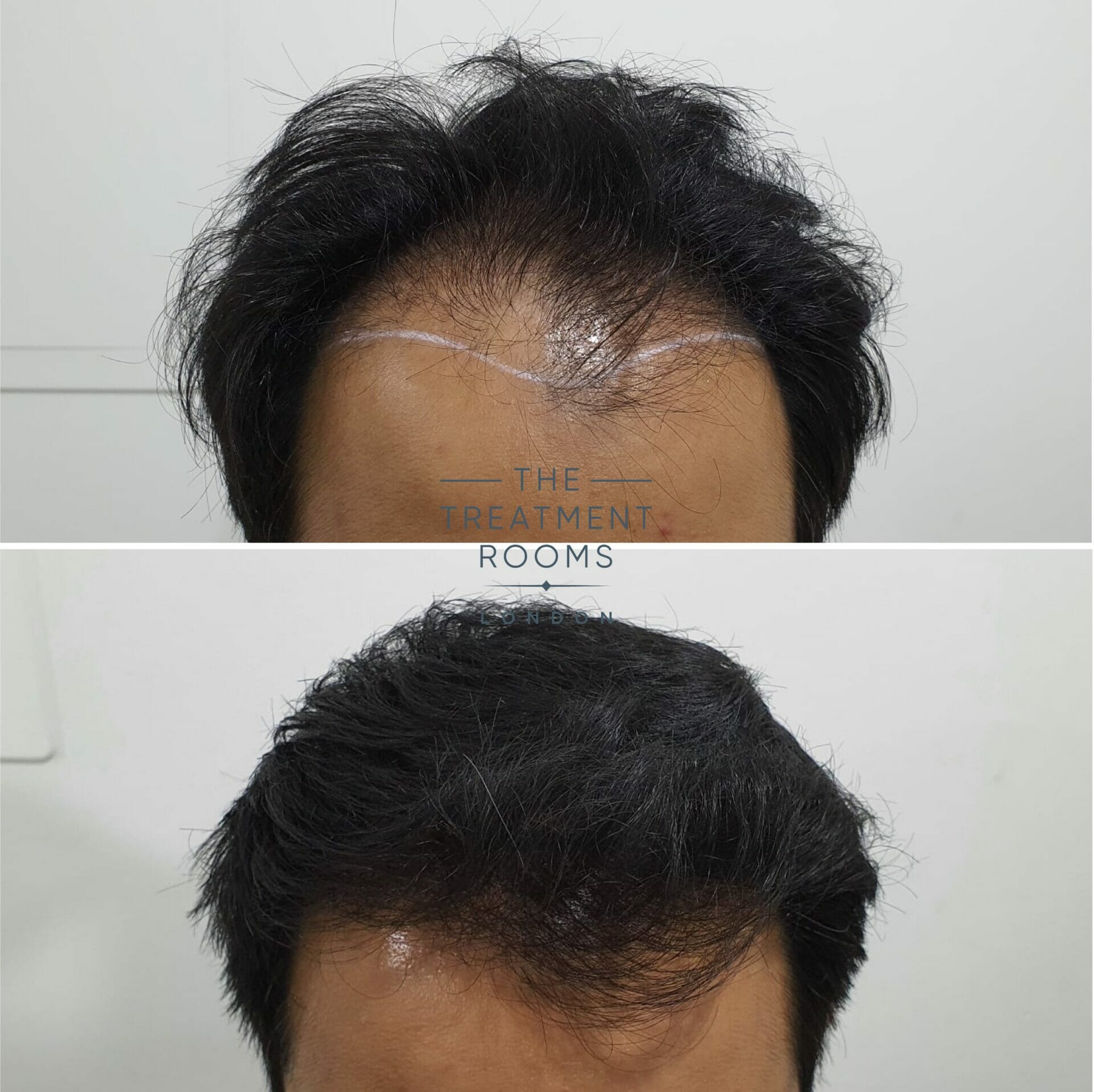 before and after fue hair transplant 1818 grafts hairline before and after fue hair transplant 1818 grafts hairline