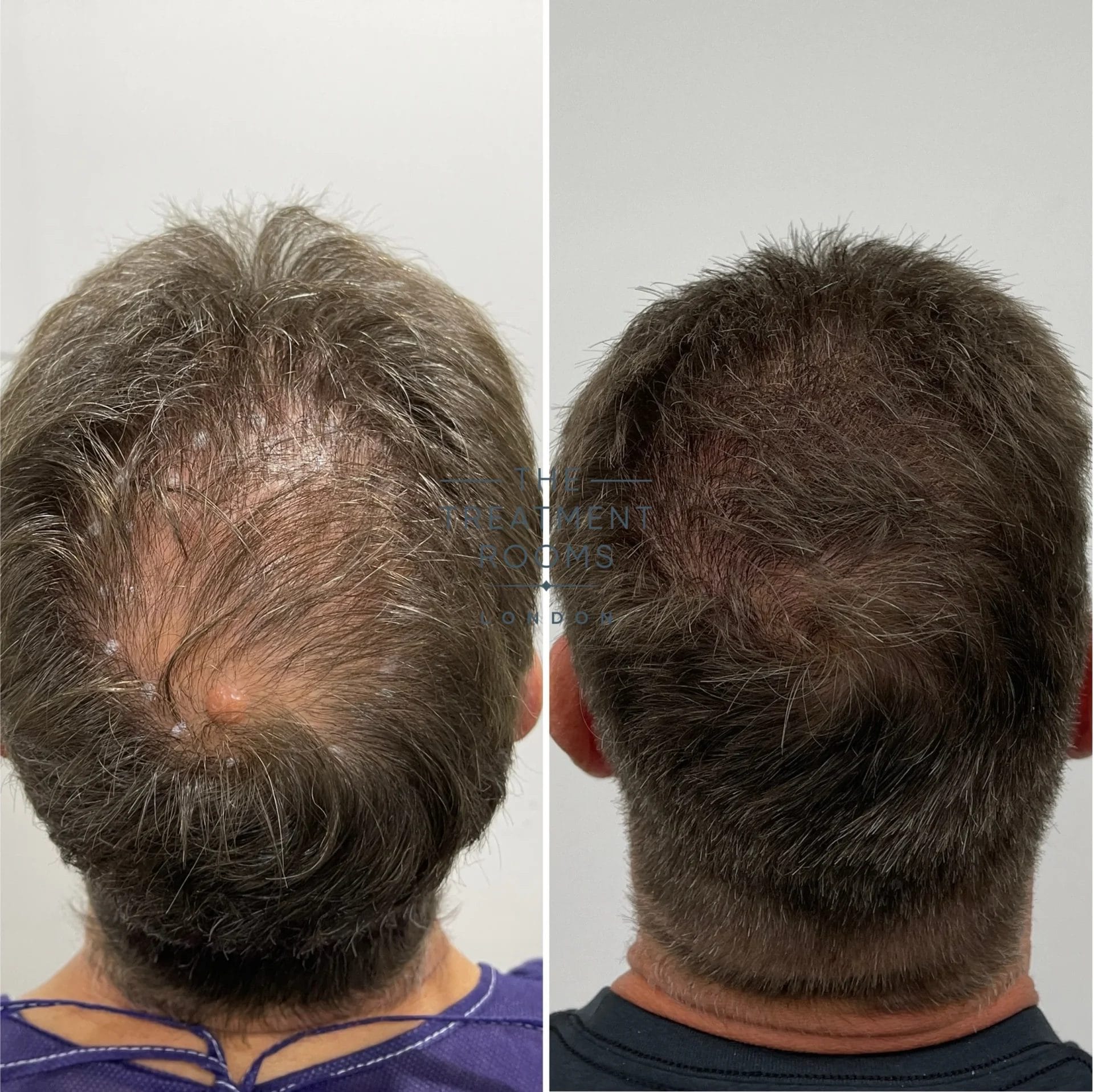 before and after hairline and crown fue transplant 2227 grafts