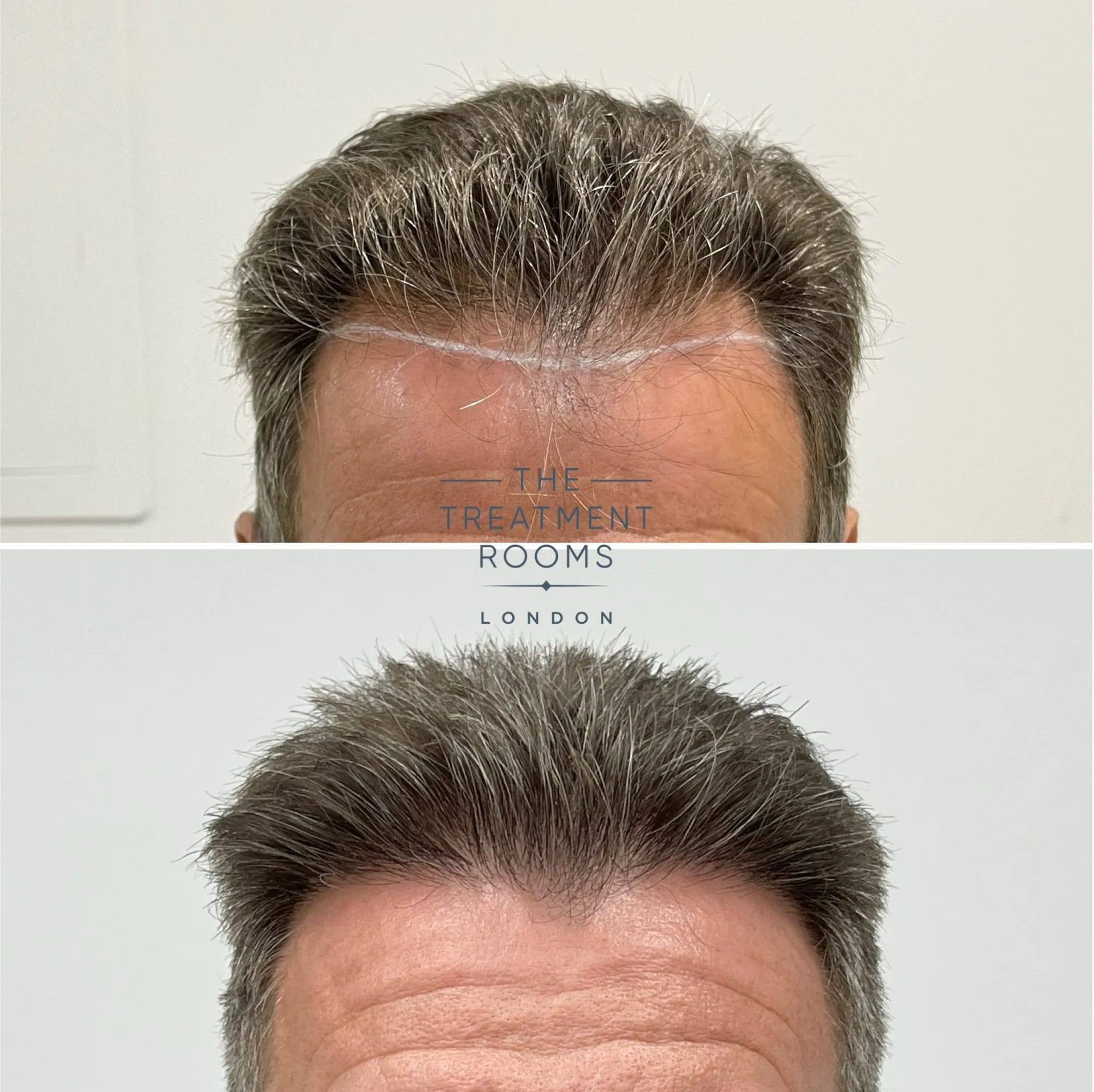 before and after hairline and crown transplant 2227 grafts