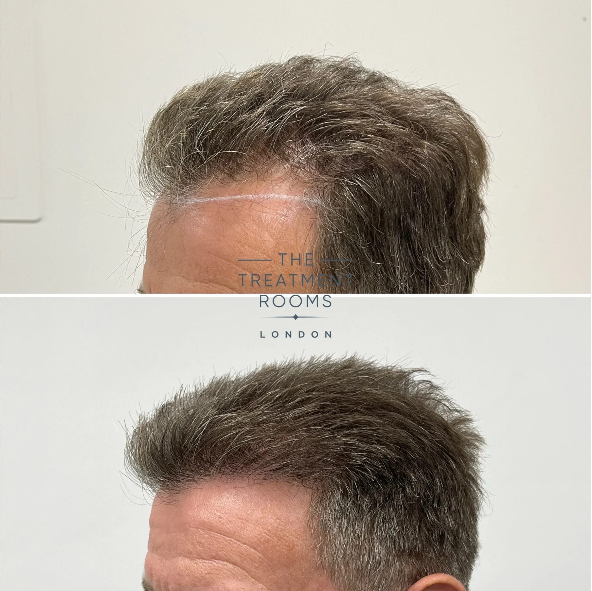 before and after hairline transplant 2227 grafts
