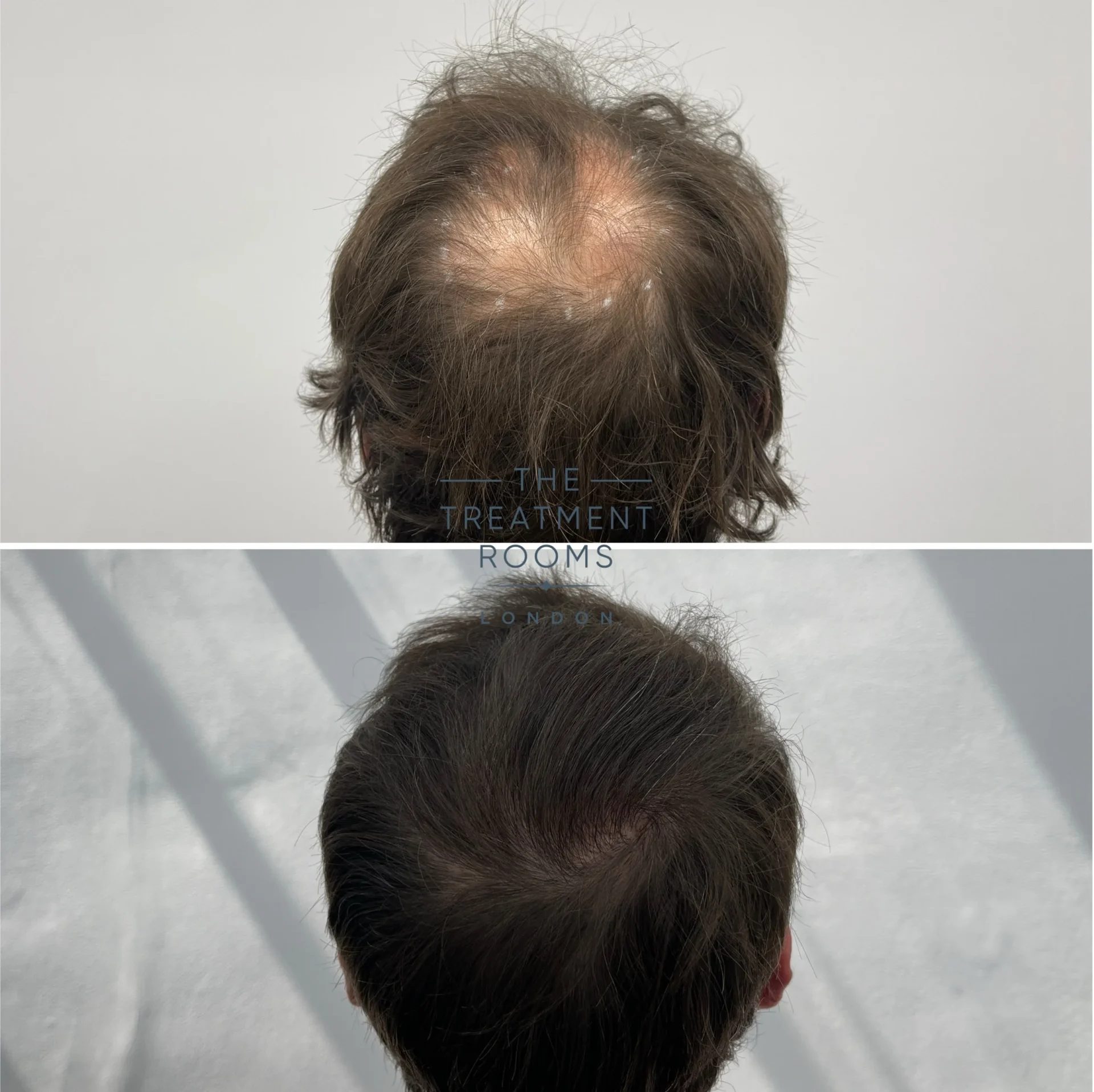 best crown fue hair transplant 3667 grafts before and after