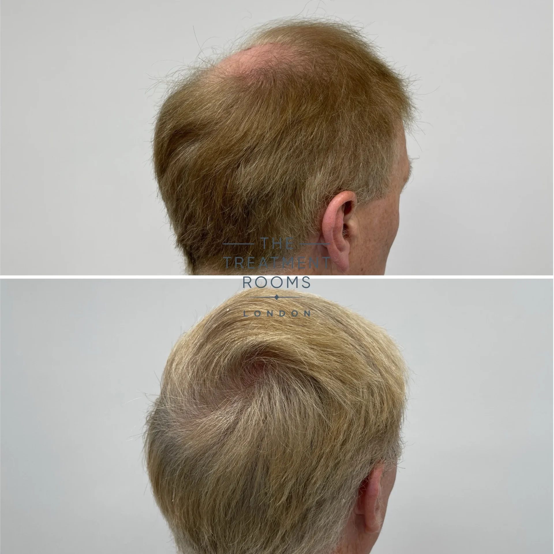 best crown fue hair transplant result 2078 grafts
