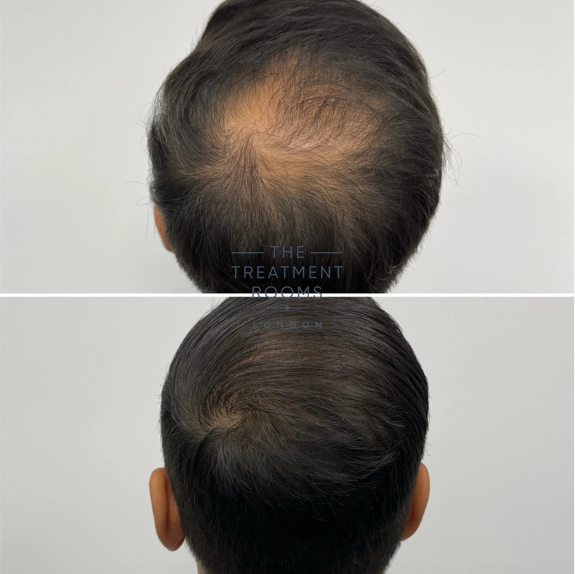 best crown hair transplant 1411 grafts result