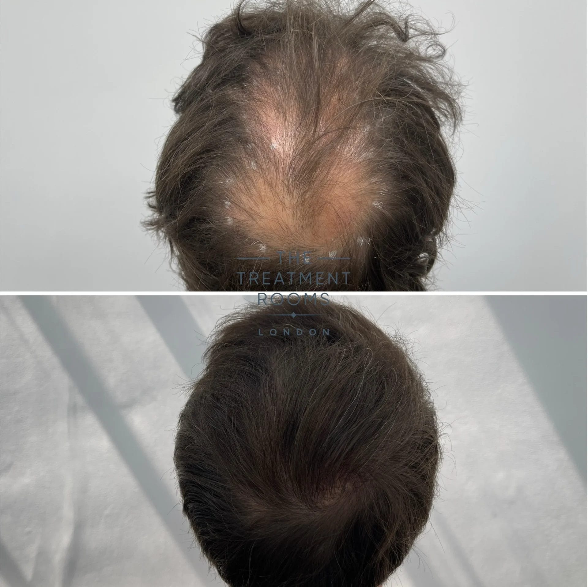best crown hair transplant 3667 grafts before and after