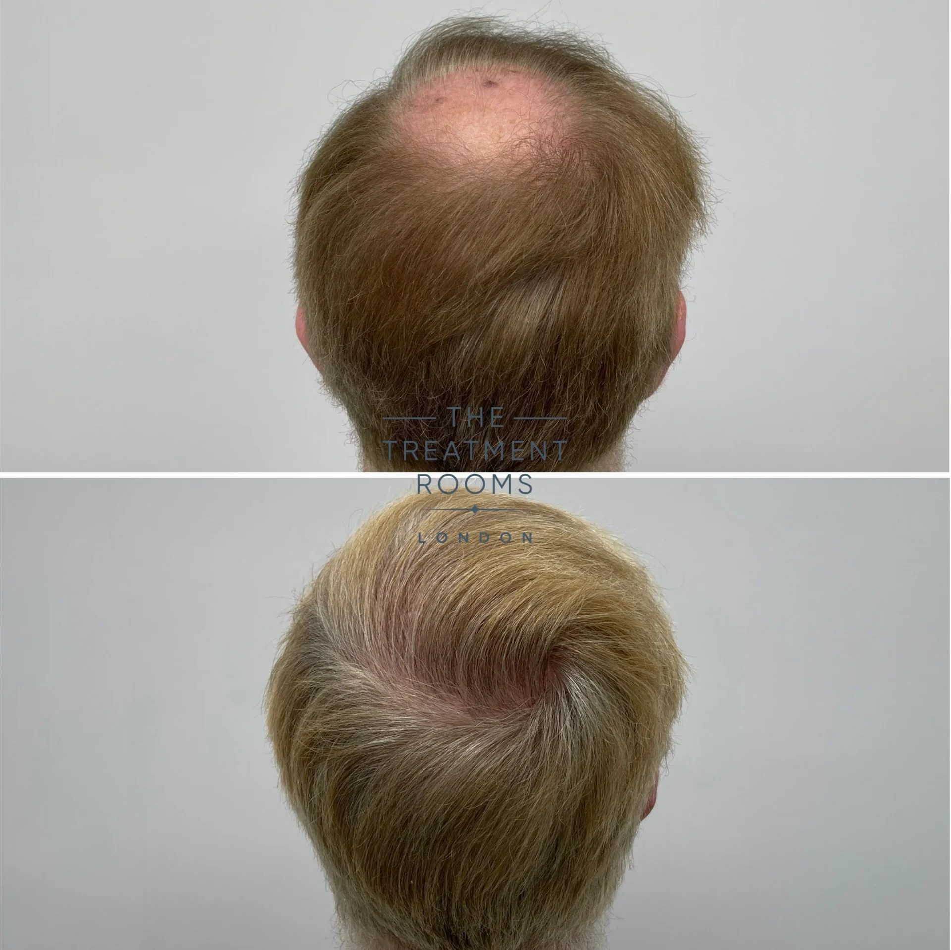 best crown hair transplant london result 2078 grafts