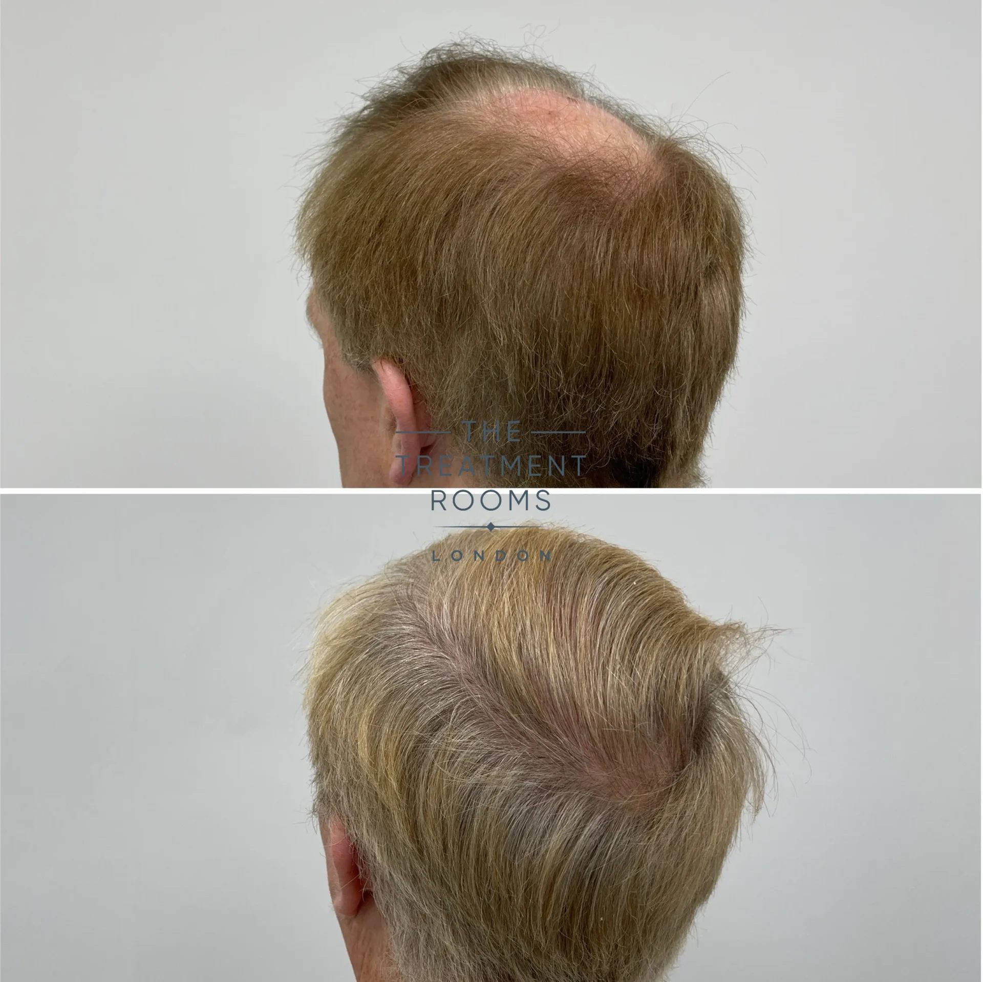 best crown hair transplant result 2078 grafts