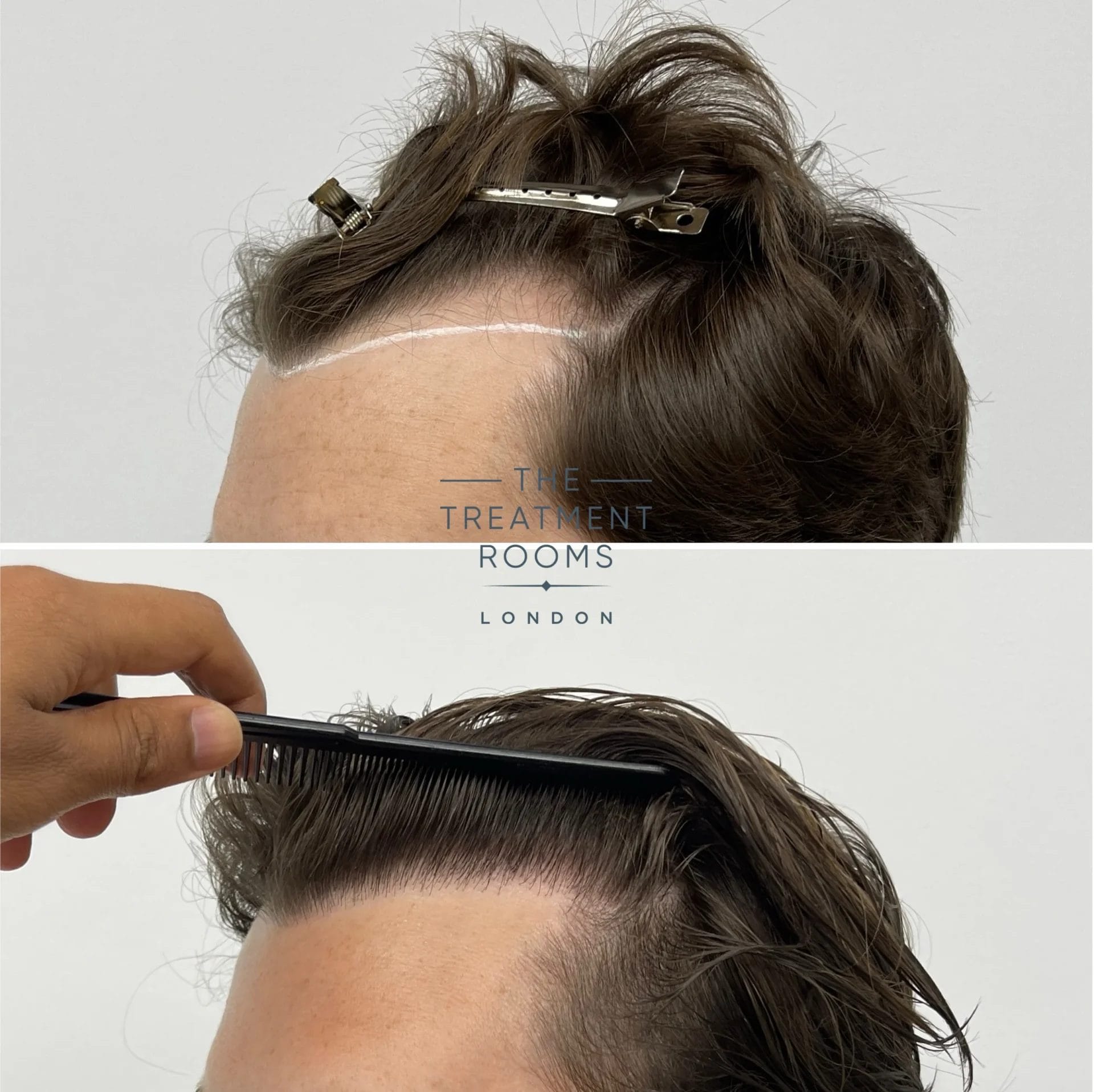 best fue hair transplant 976 grafts before and after
