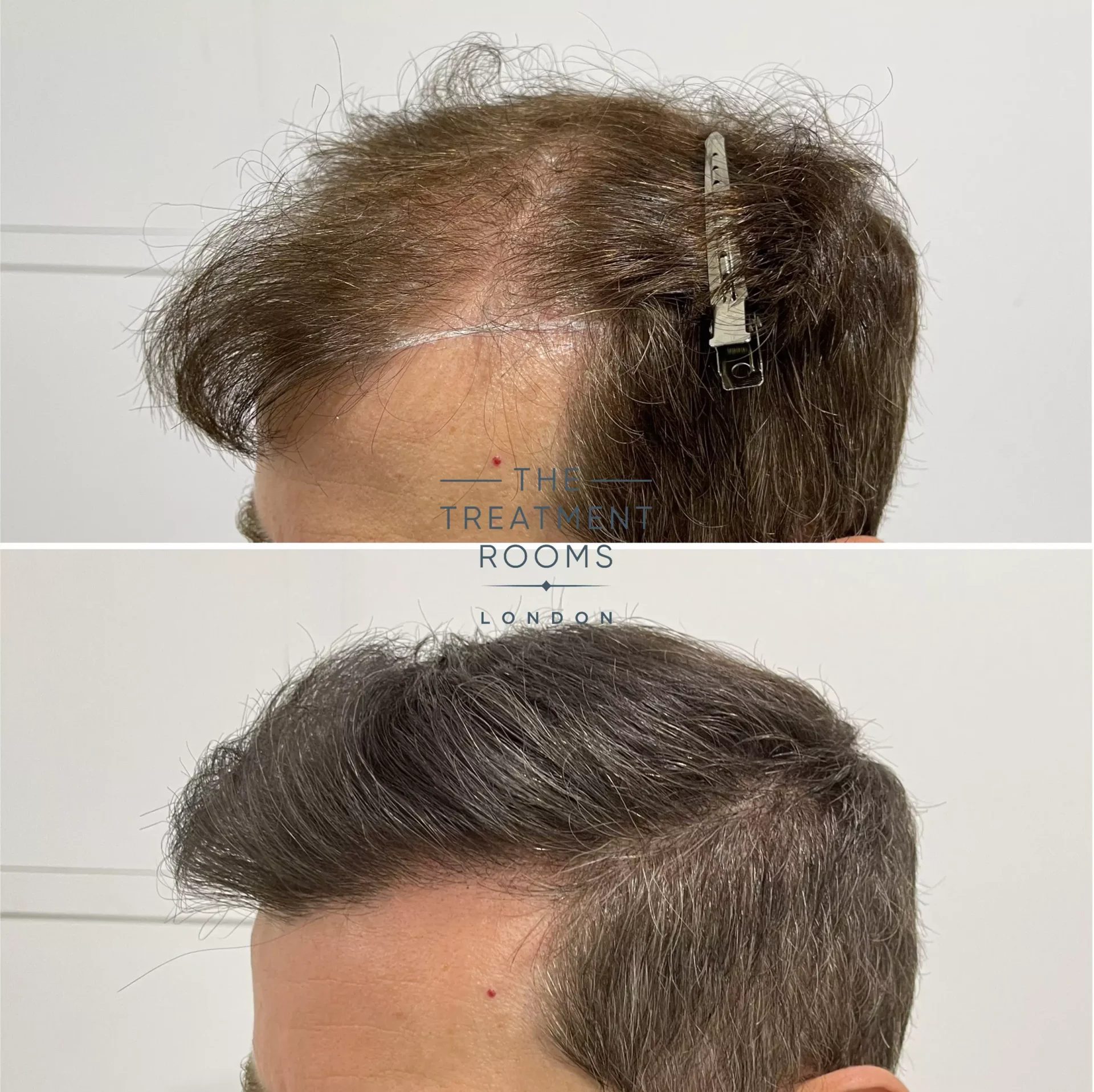 best fue hair transplant UK before and after 1491 grafts best fue hair transplant UK before and after 1491 grafts